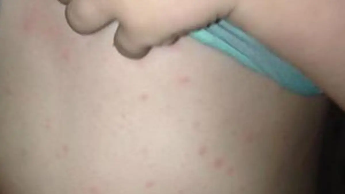 streptokokken infektion