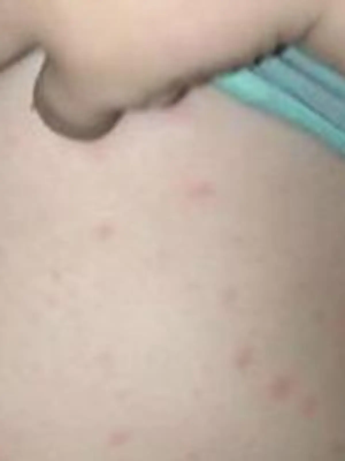 streptokokken infektion