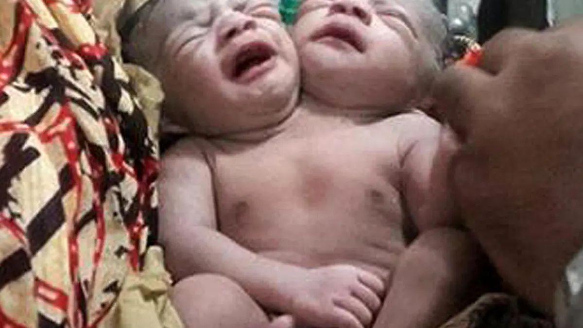 A Bangladeshi baby girl born with two heads receives medical care at a hospital in Brahmanbaria, some 120 kms east of capital Dhaka on November 12, 2015. Doctors at a Bangladesh hospital were treating a baby girl born with two heads, medical officials and the newborn's father said. The baby was born late November 11, 2015 and is now being treated for breathing difficulties after being shifted to the intensive care unit of the country's largest hospital in Dhaka. AFP PHOTO