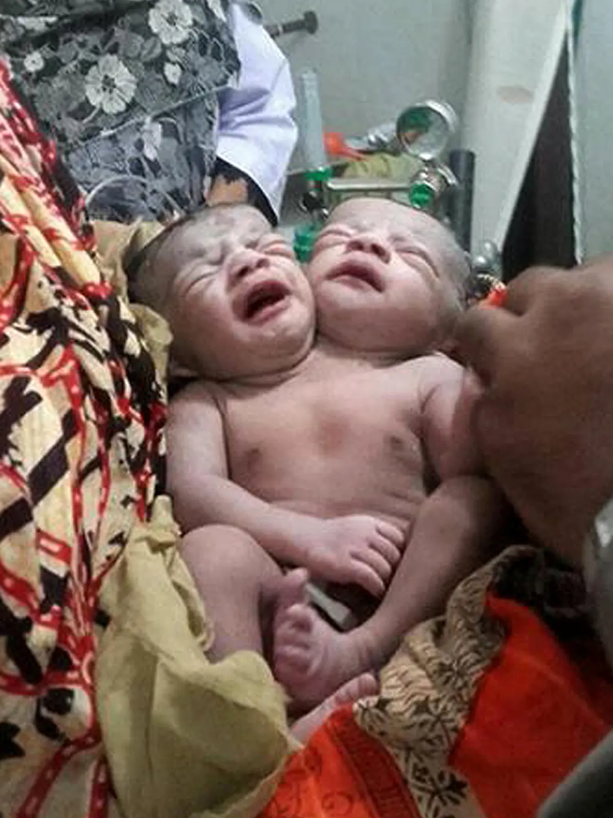 A Bangladeshi baby girl born with two heads receives medical care at a hospital in Brahmanbaria, some 120 kms east of capital Dhaka on November 12,  2015.   Doctors at a Bangladesh hospital were treating a baby girl born with two heads, medical officials and the newborn's father said. The baby was born late November 11, 2015 and is now being treated for breathing difficulties after being shifted to the intensive care unit of the country's largest hospital in Dhaka.  AFP PHOTO