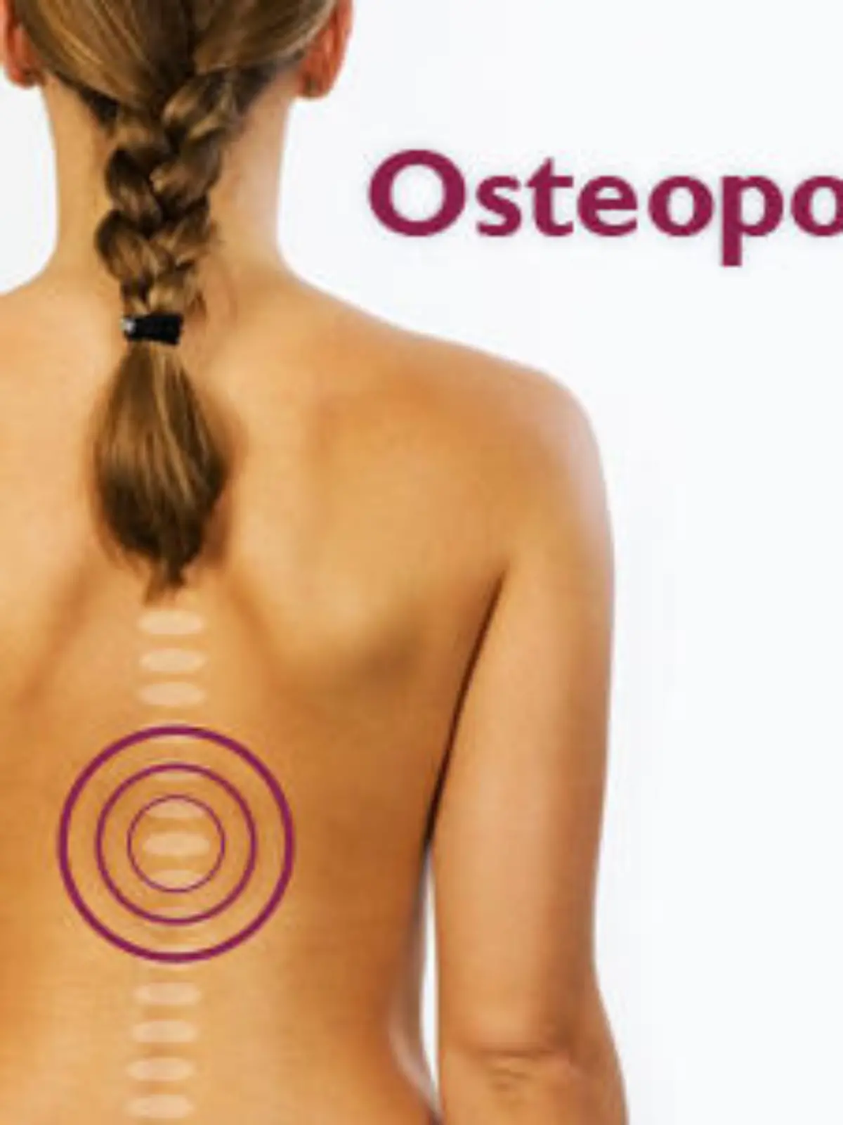 osteoporose multiteaser
