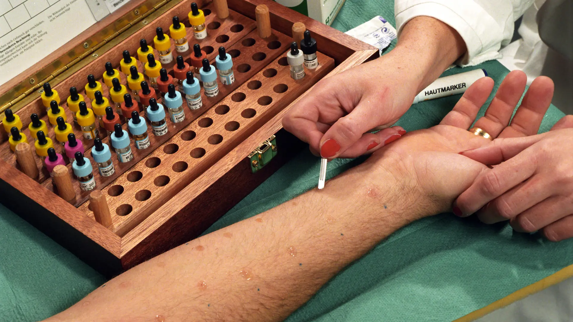 Jeder fünfte Deutsche hat Heuschnupfen, Asthma oder eine Hauterkrankung, das betrifft Erwachsene wie Kinder. In einer Arztpraxis wird der sogenannte Prick-Test durchgeführt, eine international bewährte, einfache und schnell durchführbare Methode mit hoher Aussagekraft zur Diagnostizierung von Allergien, bei der Tropfen verschiedener Allergene auf die Haut gebracht werdn und bereits nach 15 Minuten Reaktionen ablesbar sind.  Foto: Hubert Link  +++(c) dpa - Report+++