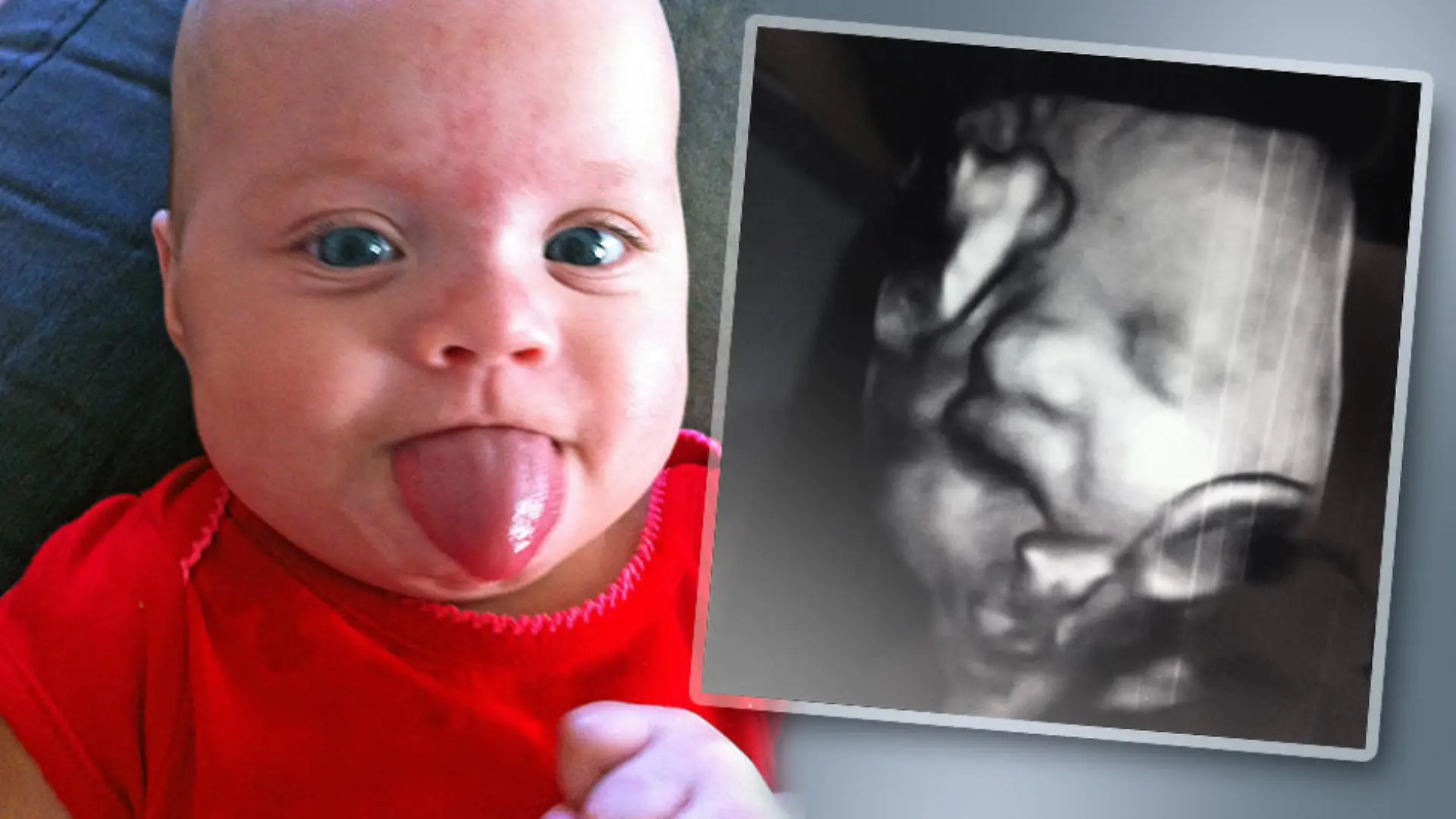 Die kleine Ocea hat das Beckwith-Wiedemann-Syndrom.