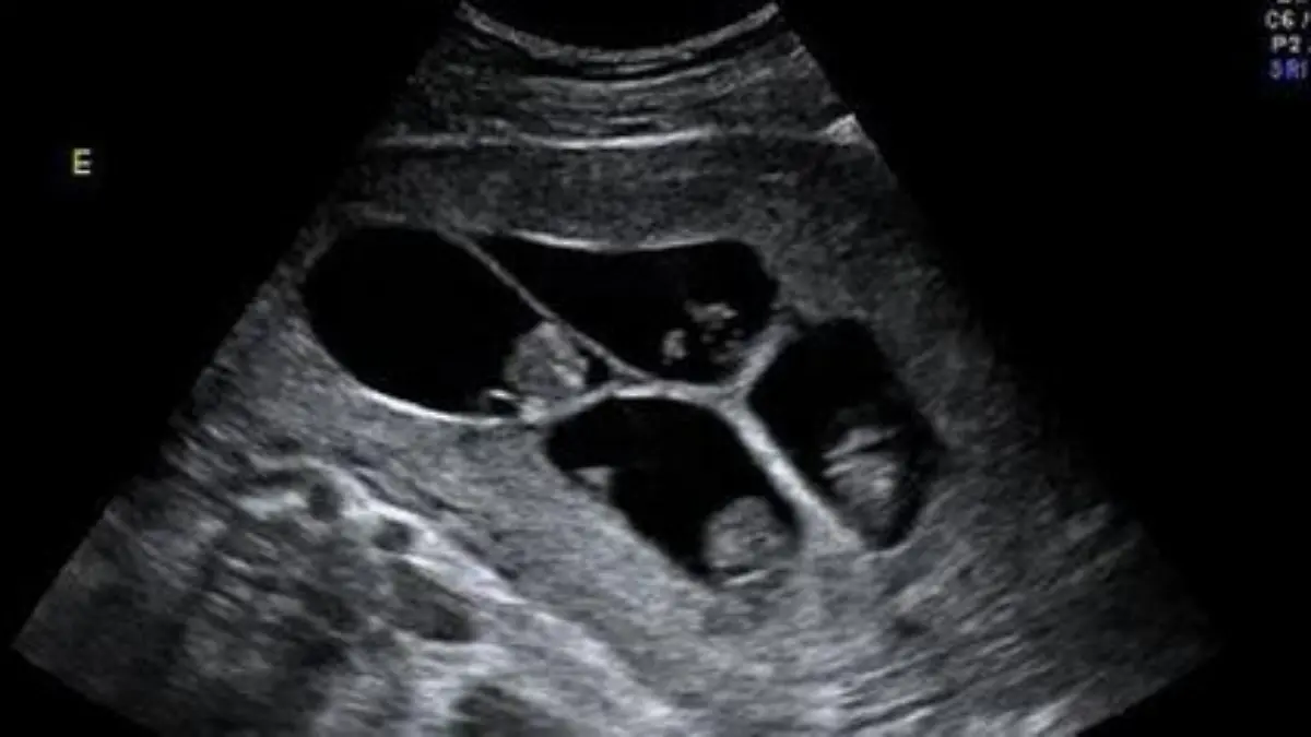 ultraschall
