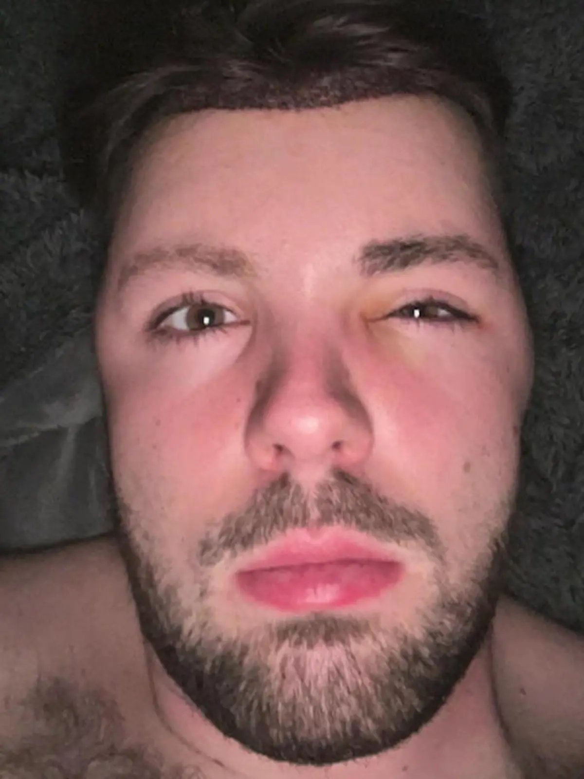 Influencer hat trotz Verbot nach Haartransplantation Sex - dann schwillt sein Gesicht an.