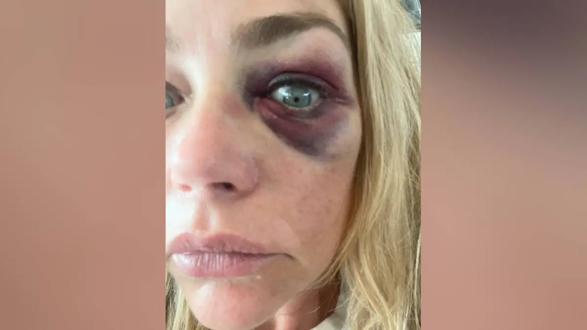 Denise Richards hat ein blaues Auge