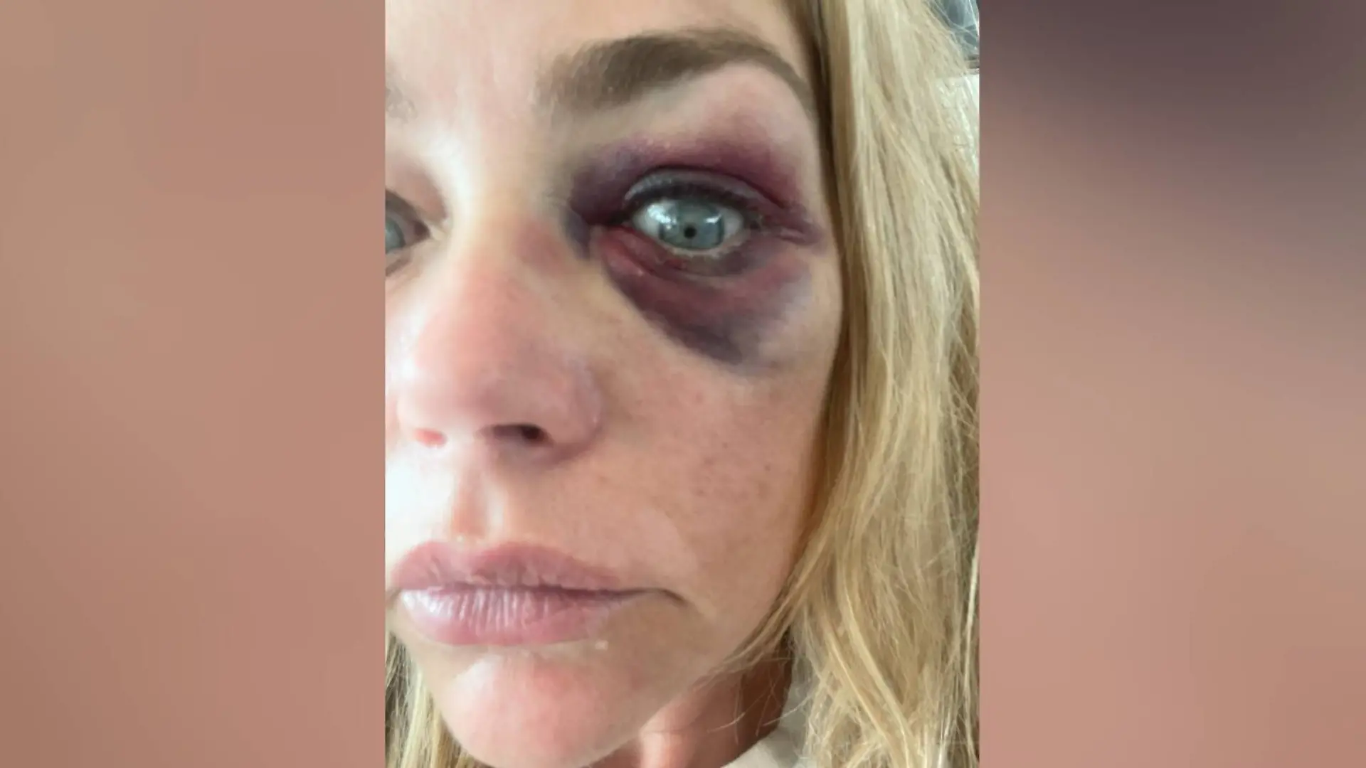 Denise Richards hat ein blaues Auge