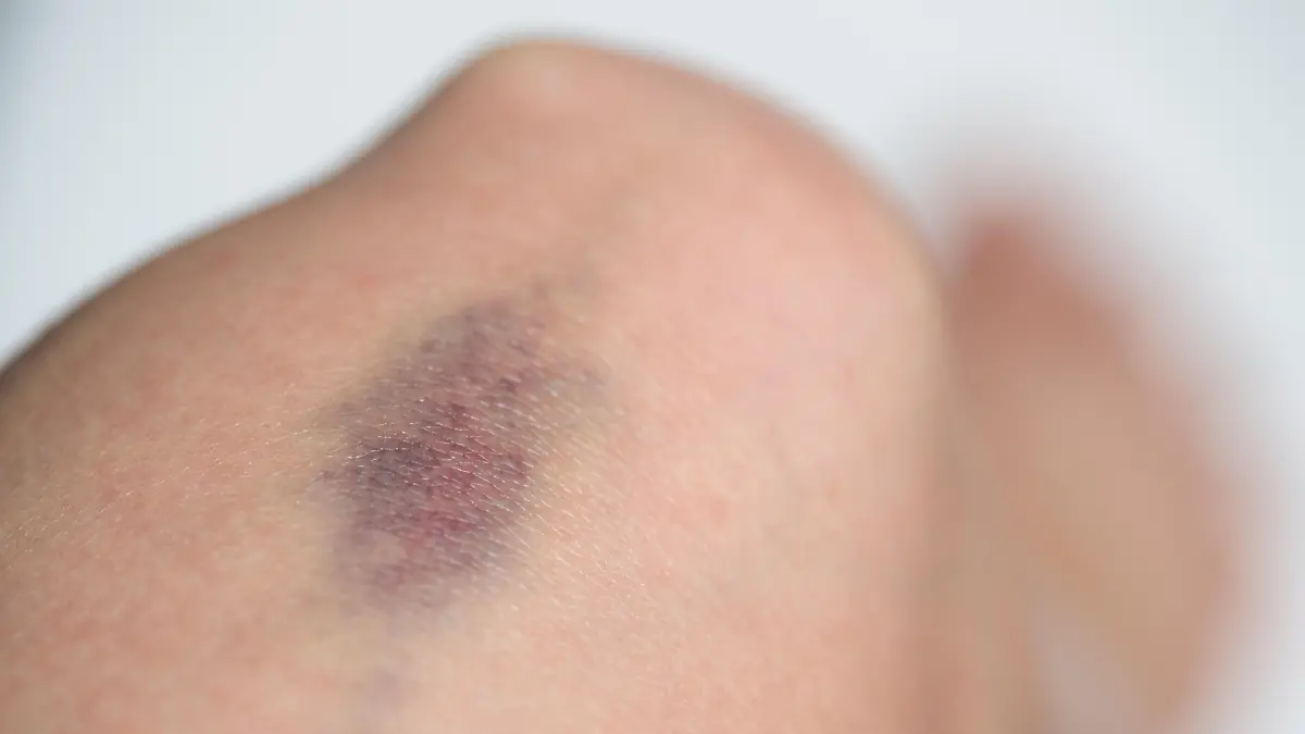 Ein blauer Fleck auf dem Knie einer Frau, aufgenommen am 07.08.2016 in Berlin. Foto: Andrea Warnecke