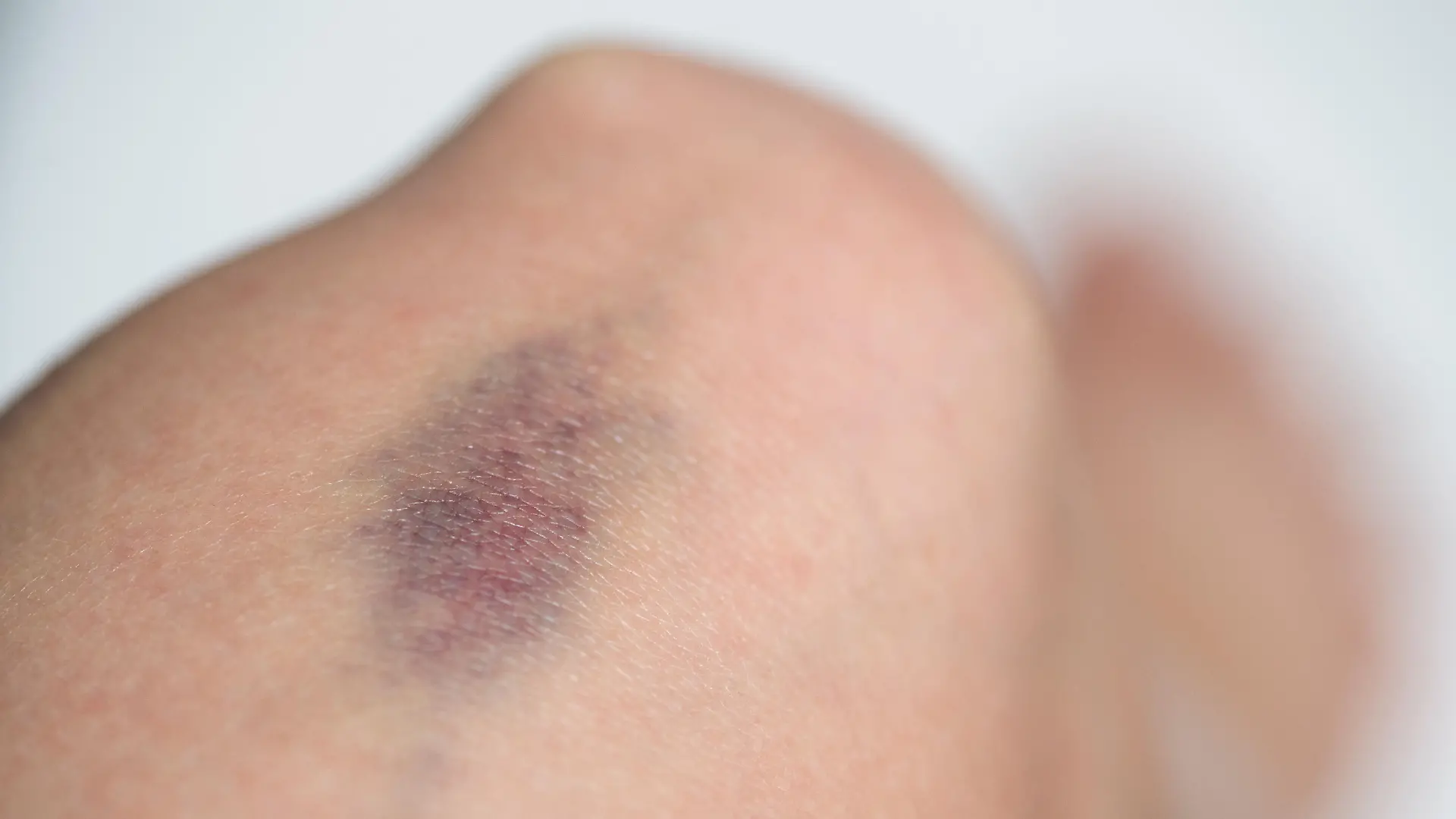 Ein blauer Fleck auf dem Knie einer Frau, aufgenommen am 07.08.2016 in Berlin. Foto: Andrea Warnecke