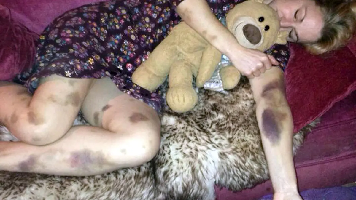 PIC FROM CATERS NEWS - (Pictured: Theas bruising after a night out in October 2014 - Thea woke up and noticed extreme bruising all over her arms and legs ) A woman was diagnosed with a rare form of leukaemia after waking up from a night out covered in mysterious bruises. After a night on the tiles, Thea Wilsons arms and legs were covered with nasty, purple bruises, but she had no idea where they had come from. After the bruising failed to subside, Thea, from Burwarton, Shrops, was told by doctors she had a platelet disorder. But after a bone marrow biopsy, her whole world came falling down when she was diagnosed with Acute Promyelocytic Leukaemia (APML) a very rare form of the blood cancer that affects only 100 people per year.