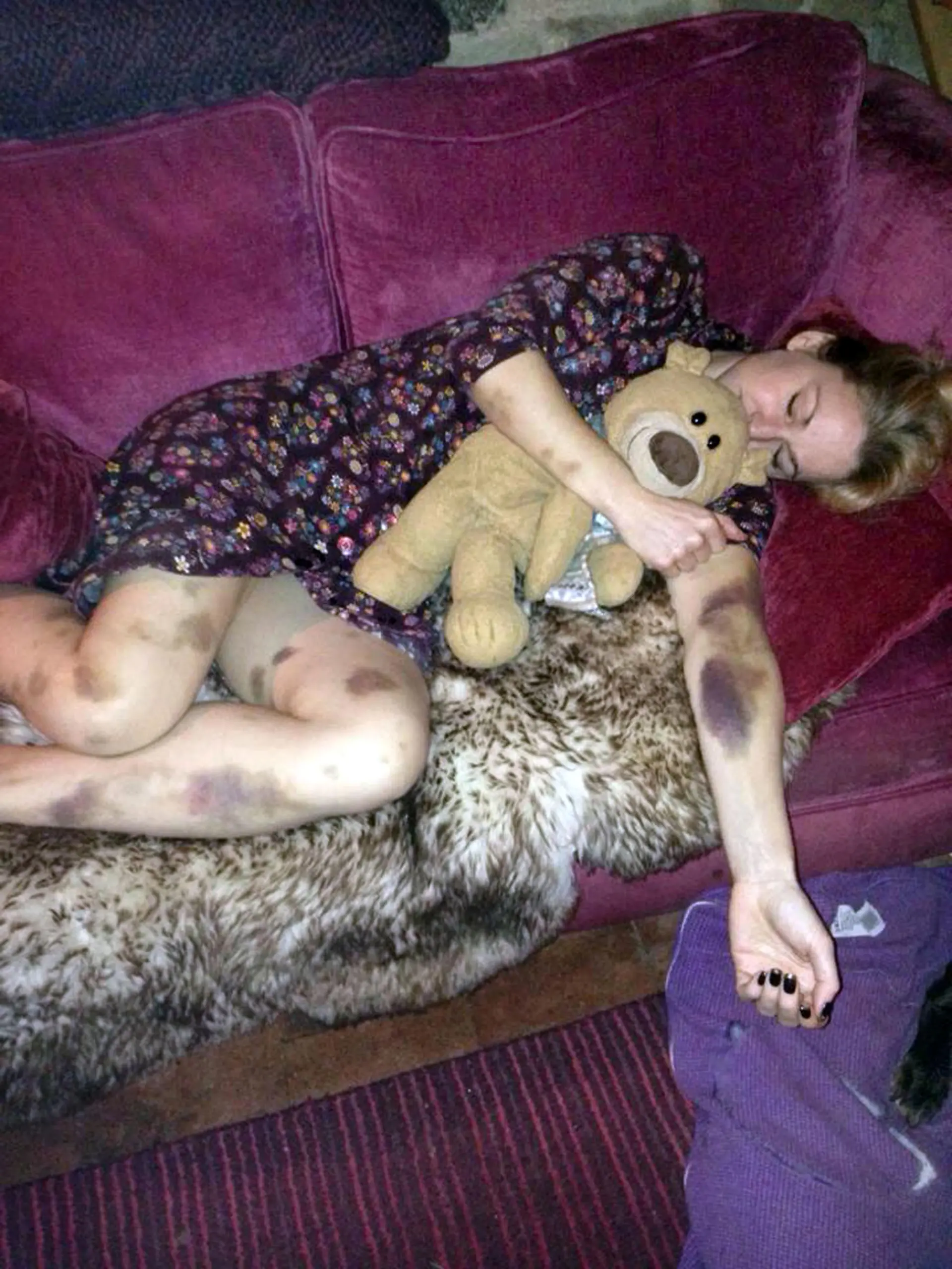 PIC FROM CATERS NEWS - (Pictured: Theas bruising after a night out in October 2014 - Thea woke up and noticed extreme bruising all over her arms and legs ) A woman was diagnosed with a rare form of leukaemia after waking up from a night out covered in mysterious bruises. After a night on the tiles, Thea Wilsons arms and legs were covered with nasty, purple bruises, but she had no idea where they had come from. After the bruising failed to subside, Thea, from Burwarton, Shrops, was told by doctors she had a platelet disorder. But after a bone marrow biopsy, her whole world came falling down when she was diagnosed with Acute Promyelocytic Leukaemia (APML)  a very rare form of the blood cancer that affects only 100 people per year.