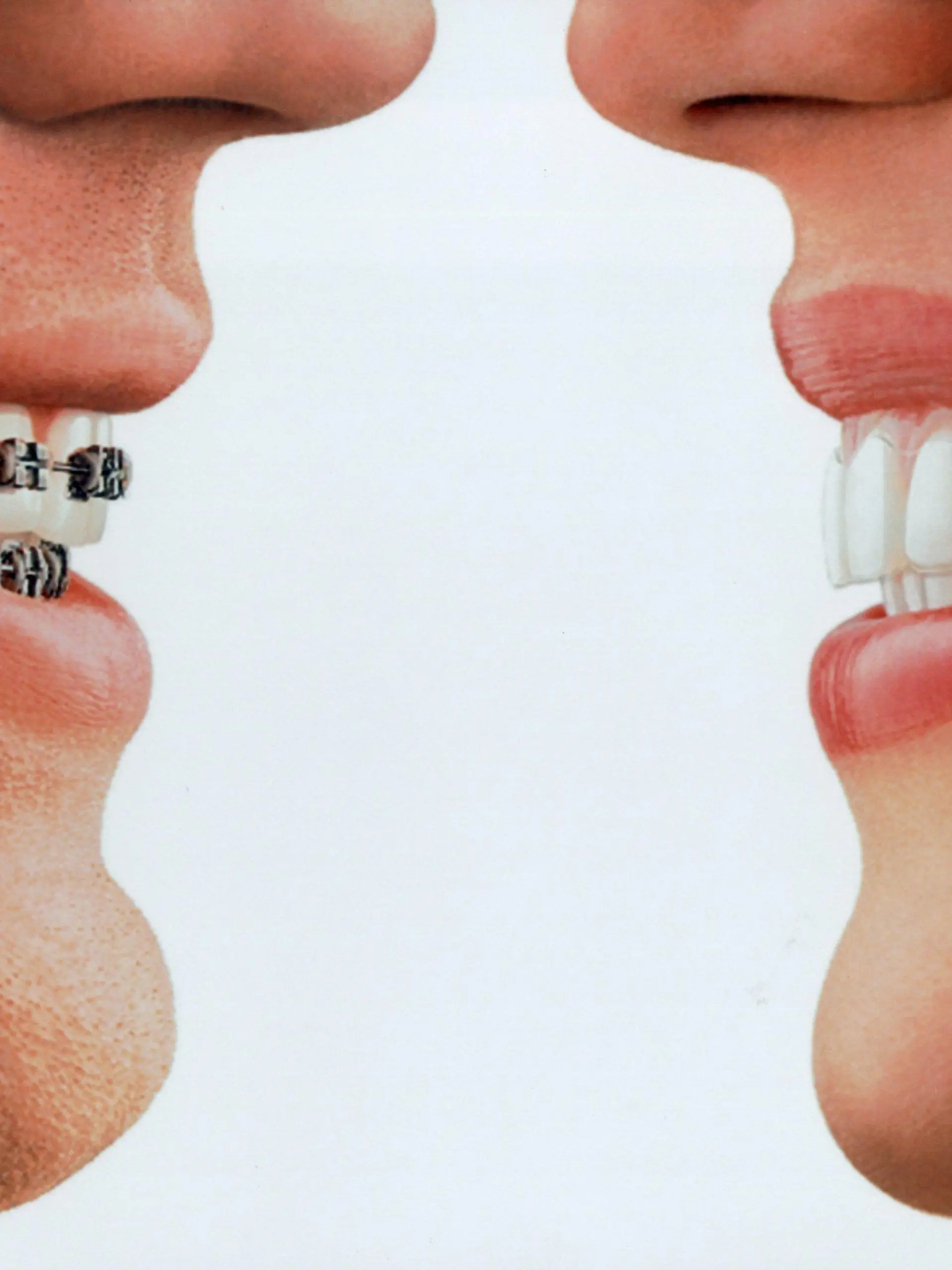 Das am 22.08.2001 von der Charité Berlin veröffentlichte Foto zeigt eine herkömmliche silberne Zahnspange (l) und ein neues unsichtbares Zahnkorrektursystem (r). Das patentierte Invisalign-System aus dem kalifornischen Silicon Valley wurde erstmals in Deutschland vom Berliner Universitätsklinikum getestet. Statt mit Silberdrähten, die unangenehm für Zunge und Wangen sind, arbeitet das System mit einem starren, farblosen Plastiküberzug, der die Zahnstellung korrigiert. - Die erste elastische Zahnspange gab es Ende der 30-er Jahre. Ihr Erfinder, der Görlitzer Zahnarzt Georg Klammt, ist am Mittwoch (27.02.2002) 95 Jahre alt geworden. dpa (zu lsn 105 vom 27.02.2002)