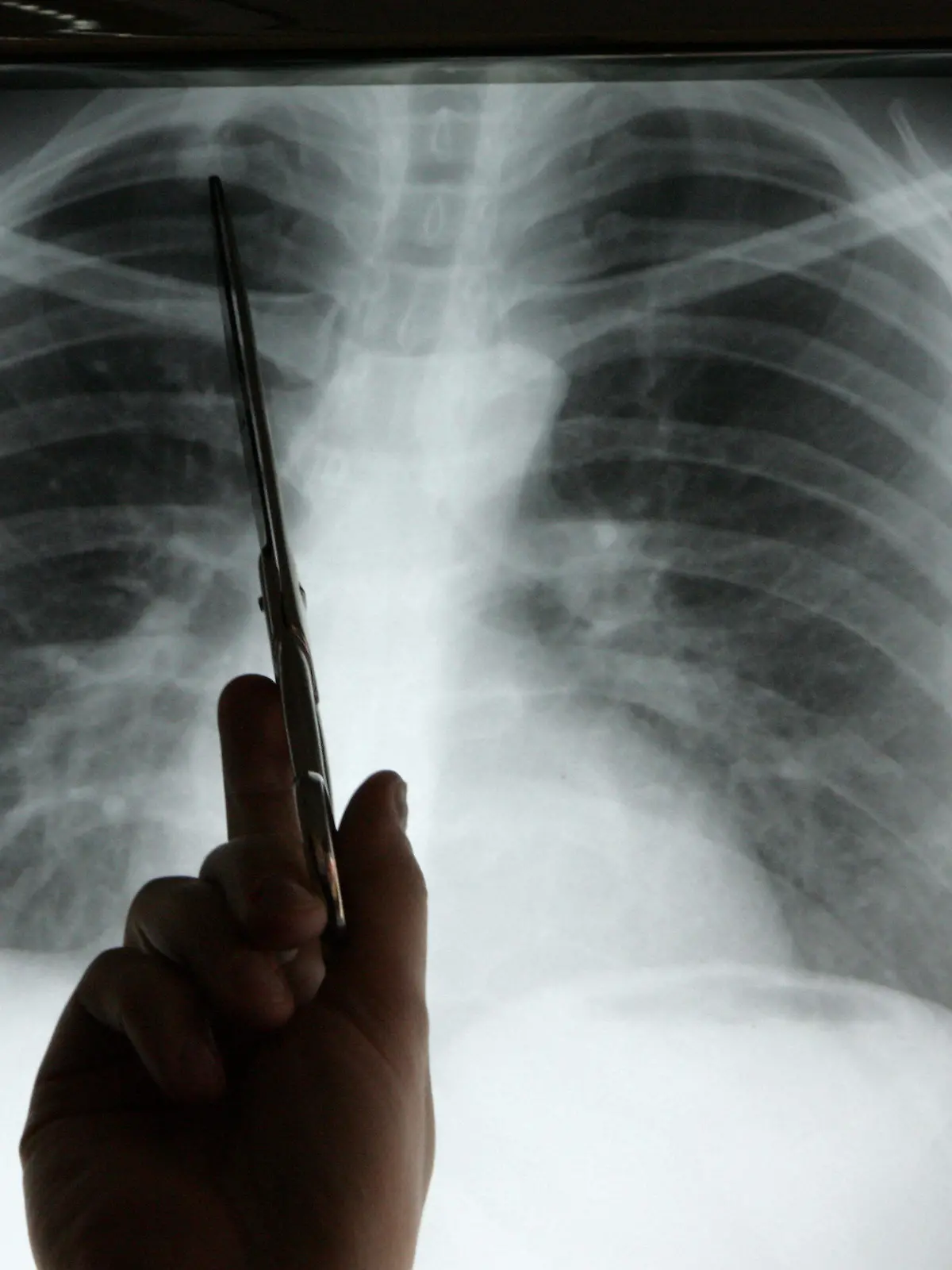 ARCHIV - Die Diagnose Lungenkrebs musste Nicolas Dickgreber dem 1968 geborenen Patienten mit diesem Röntgenbild geben, auf das er in der Medizinischen Hochschule Hannover (MHH) zeigt (Foto vom 15.11.2006). In Deutschland wird nach einer Schätzung des Robert-Koch-Instituts (RKI) im Jahr 2010 fast jede Minute eine neue Krebsdiagnose gestellt, wird am Dienstag (23.02.2010) in Berlin mitgeteilt. Foto: Rainer Jensen dpa/lbn (zu lbn 4077 vom 23.02.2010)  +++(c) dpa - Bildfunk+++
