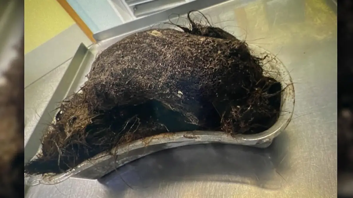 So groß wie eine Melone! Erin (14) hat riesigen Haarball im Bauch Von wegen Glutenunverträglichkeit!
