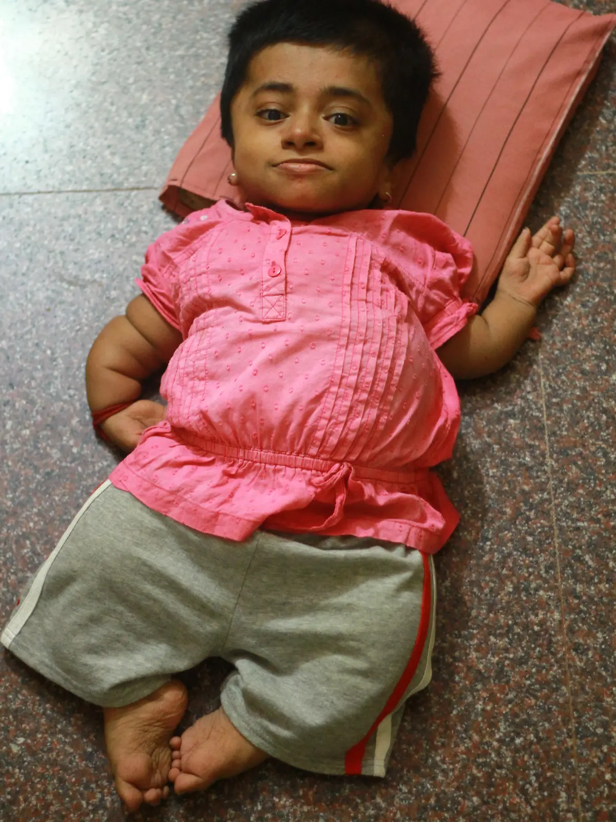 Honorarabsprache! Furchtbar! 19-jährige im Körper eines Kleinkindes gefangen. - *** EXCLUSIVE - VIDEO AVAILABLE ***BANGALORE, INDIA - SEPTEMBER 30: 19-year-old Girija Srinivas' head is unable to move her neck for feature of causing a fracture, on September 30, 2014, in Bangalore, India. SHE may look like a toddler ? but Girija Srinivas is actually a teenager trapped in a two-year-old?s body. The 19-year-old, from Bangalore in India, was born with congenital agenesis, meaning her limbs failed to fully develop and leaving her just two and a half feet tall and weighing a mere 12kg. Girija's condition means she is unable to stand or even sit-up and she relies on her mother to care for her and feed here.  But against the odds, and with her friends and family behind her, Girija is carving out a career as an artist. She makes between 8,000 and 10,000 rupees (£86-108) selling her drawings each month, and dreams of one day achieving fame and independence. PHOTOGRAPH BY Barcroft IndiaUK Office, London.T +44 845 370 2233W www.barcroftmedia.comUSA Office, New York City.T +1 212 796 2458W www.barcroftusa.comIndian Office, Delhi.T +91 11 4053 2429W www.barcroftindia.com