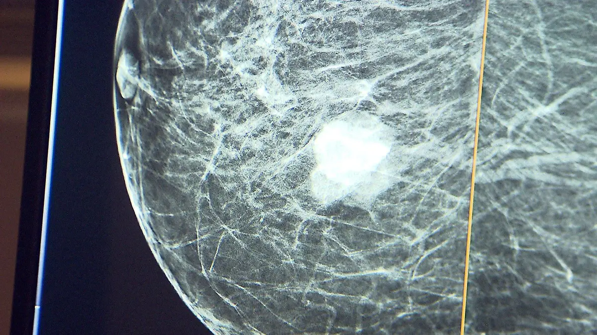 1,8 cm ist der aggressive Tumor groß, als er entdeckt wird. Ohne die Früherkennung wäre die Heilungschance nicht so positiv gewesen.
