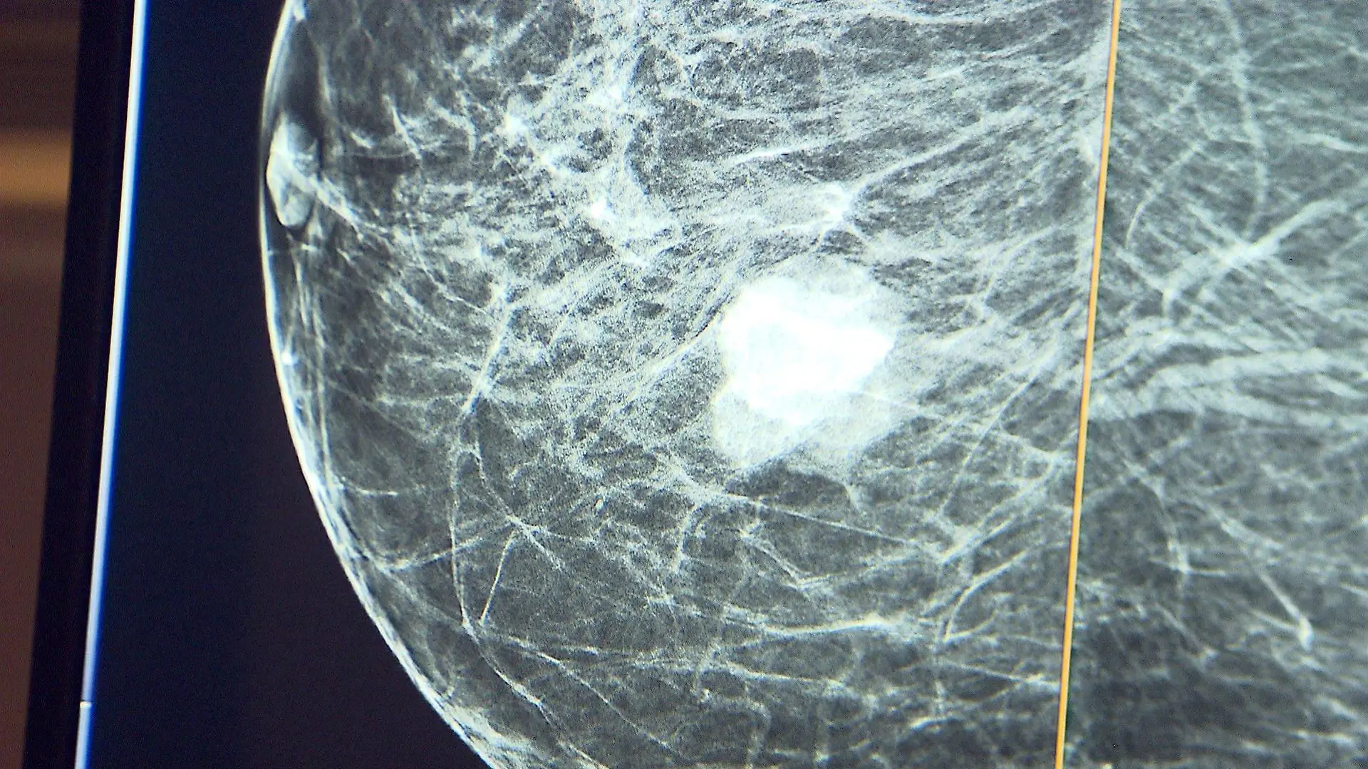1,8 cm ist der aggressive Tumor groß, als er entdeckt wird. Ohne die Früherkennung wäre die Heilungschance nicht so positiv gewesen.
