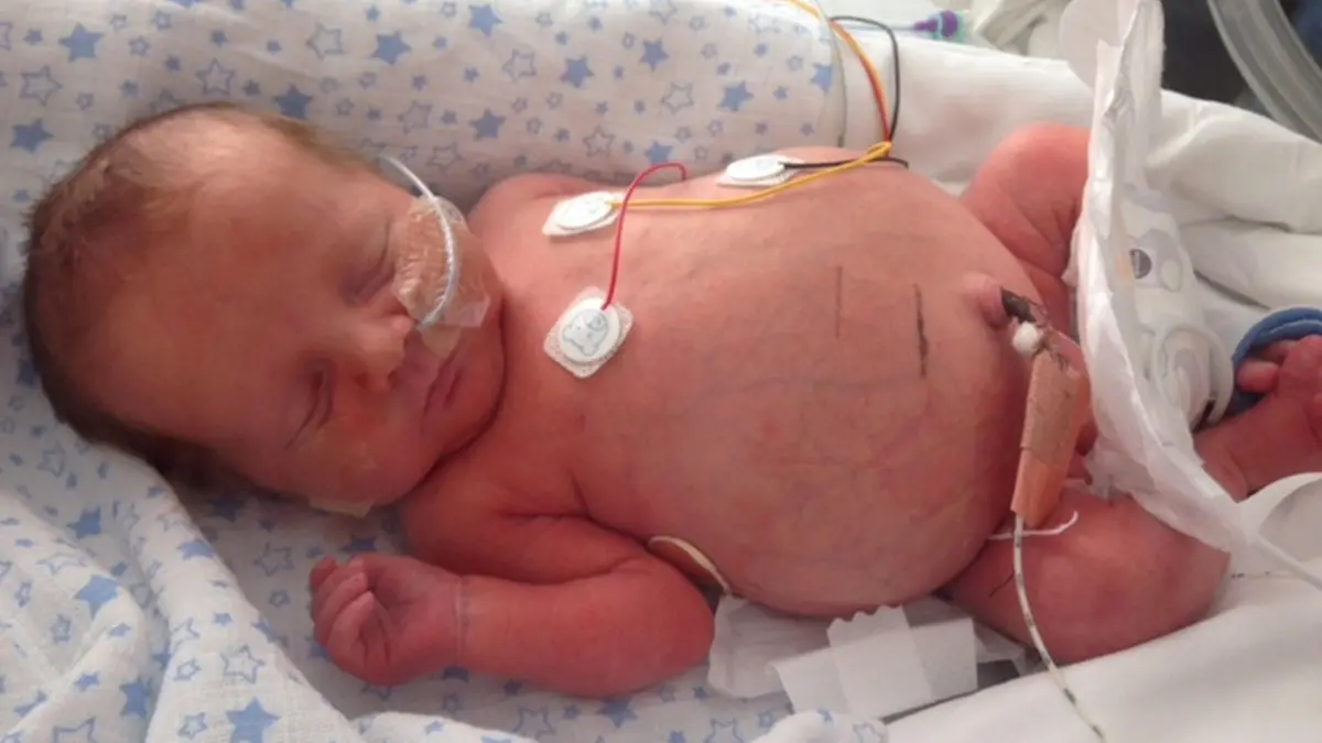 PIC FROM CATERS NEWS AGENCY - (PICTURED: MILES AS A BABY.) - An adorable baby who was born with a SWOLLEN STOMACH the size of FOOTBALL has made a remarkable recovery. Stacey Skinner, 28, from Hellesdon, Norwich, was shocked when her son, Miles, was born with a huge bulging belly. Due to a rare condition known as chylous ascites, the little tots tummy had swollen to the size of a football in the womb. Even before he was born, Miles had almost a pint of liquid drained from his stomach, and remained in hospital for a further 12 weeks before it reduced to its normal size. But despite his dramatic start to life, Miles has made a fantastic recovery, and is finally at home with his family. SEE CATERS COPY