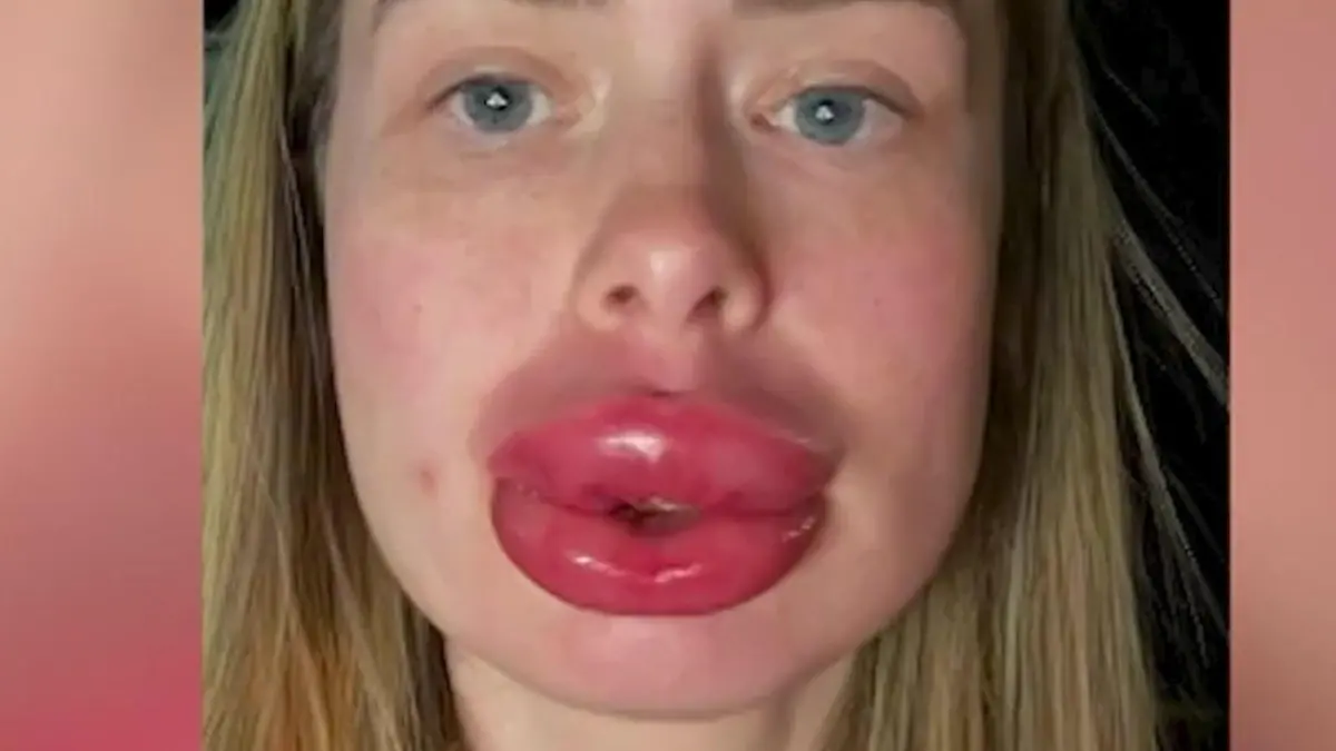 XXL-Beauty-Fail! Jessicas (30) Lippen hören nicht mehr auf zu wachsen Kurz vor der Hochzeit 