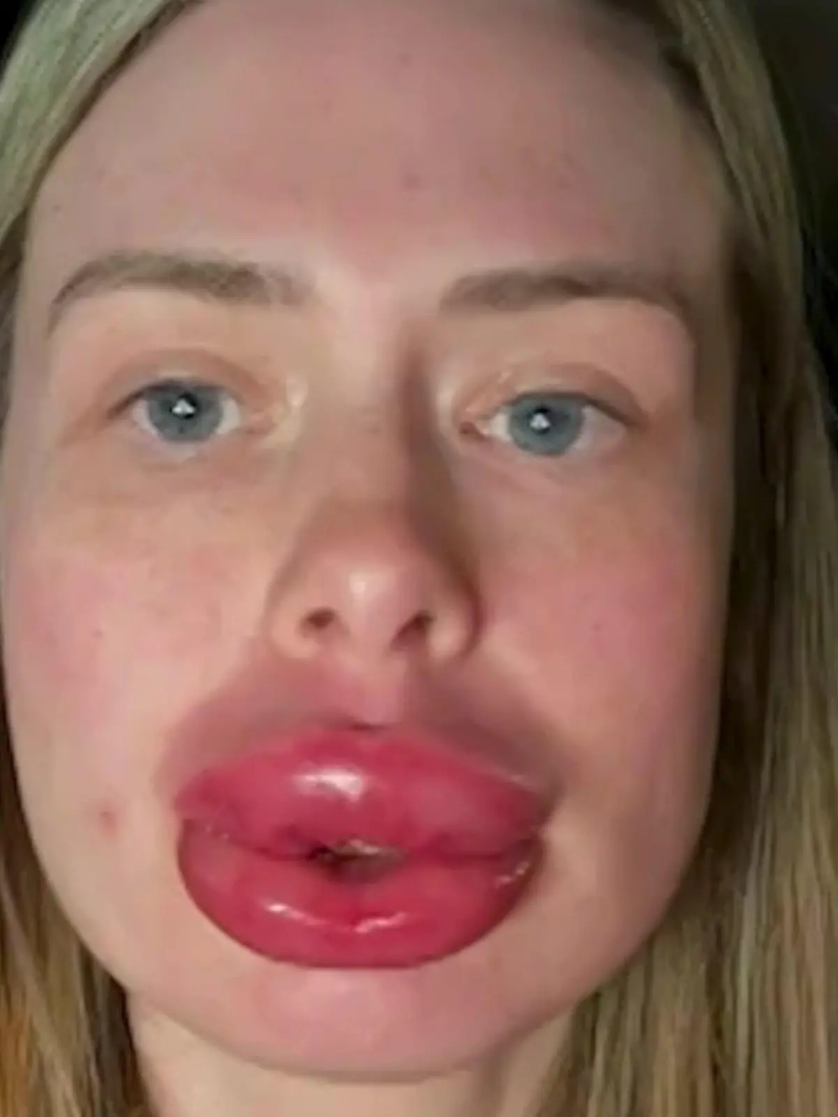 Bild zu: "XXL-Beauty-Fail! Jessicas (30) Lippen hören nicht mehr auf zu wachsen"