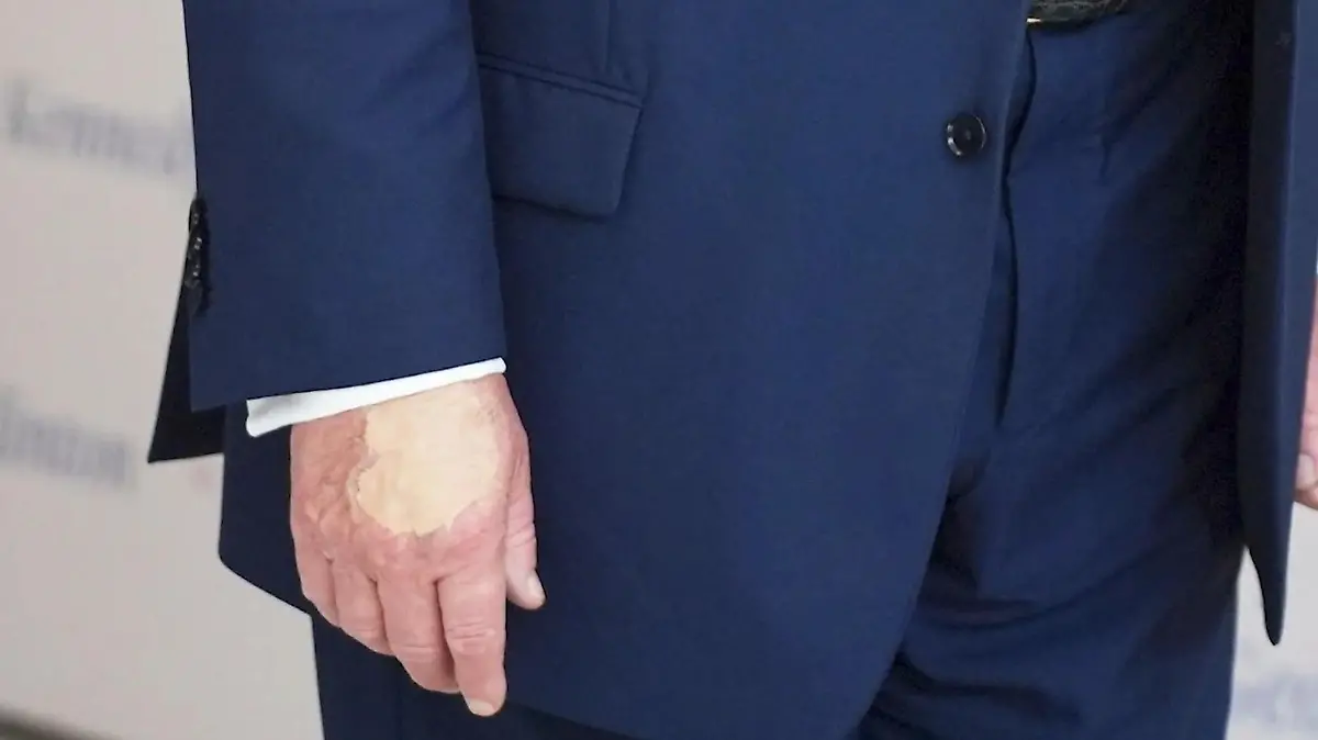 Wieder Wirbel um Donald Trumps Hände! Wie krank ist der US-Präsident wirklich? Foto zeigt komische Flecken