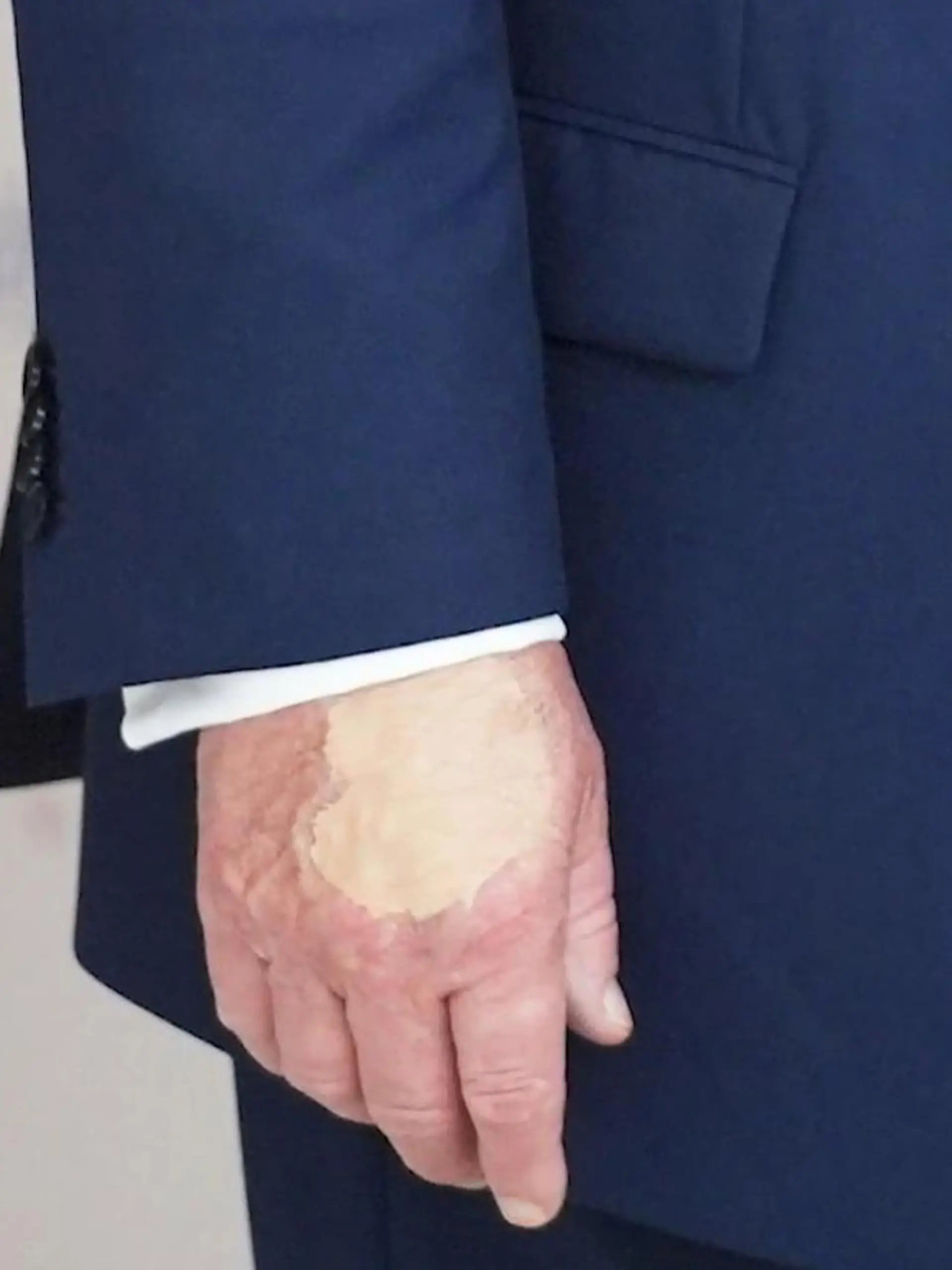 Bild zu: "Wieder Wirbel um Donald Trumps Hände! Wie krank ist der US-Präsident wirklich?"