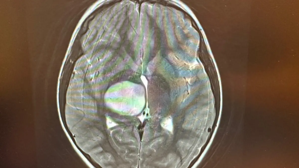 Ein hühnereigroßer Tumor sitzt in Isabellas Kopf.