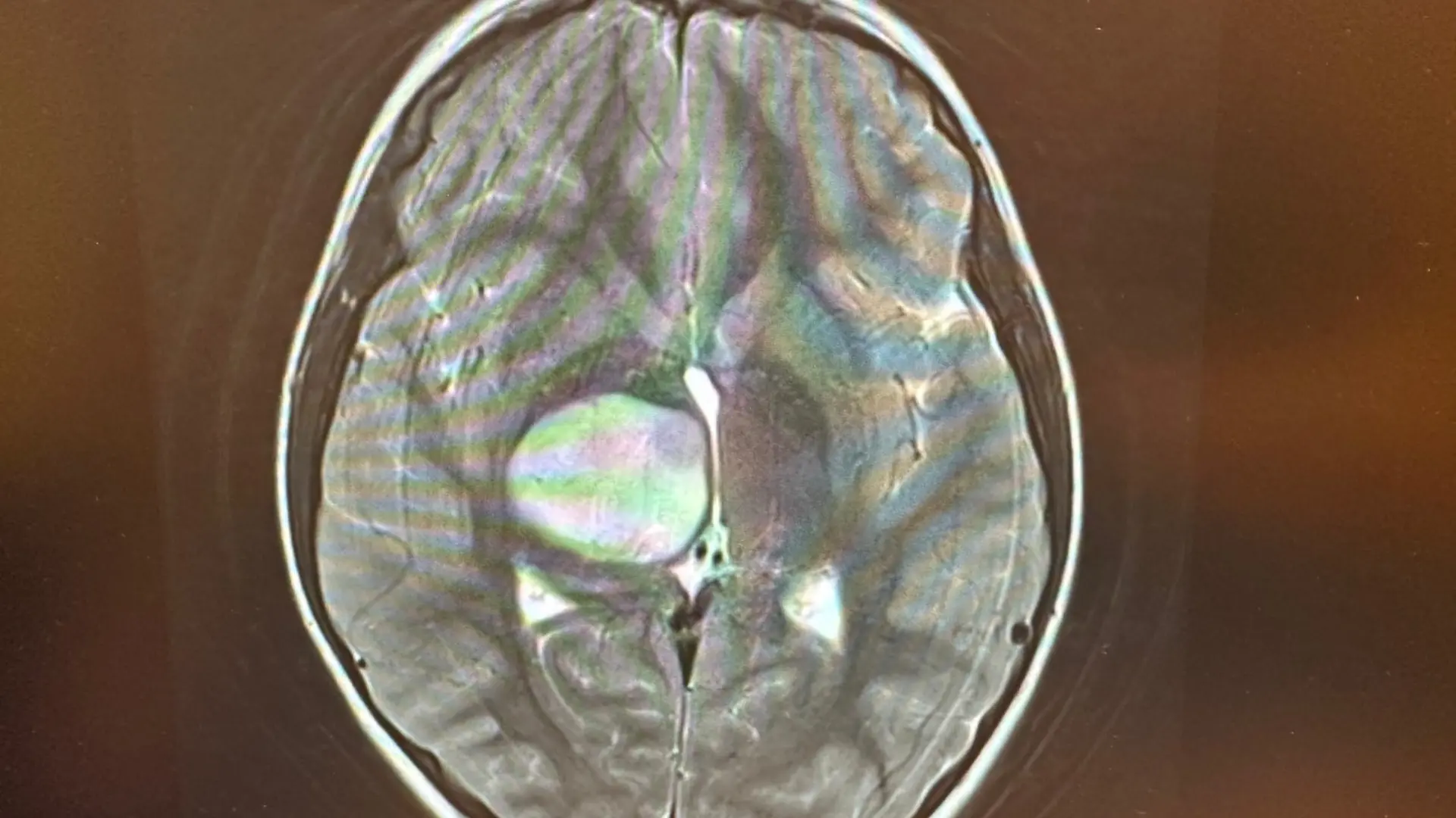 Ein hühnereigroßer Tumor sitzt in Isabellas Kopf.