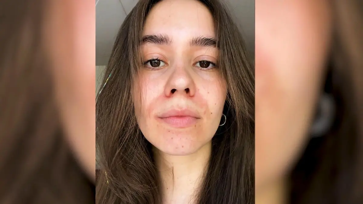 Lin hatte periorale Dermatitis - woher kommt das und was hilft? Wenn Hautpflege krank macht