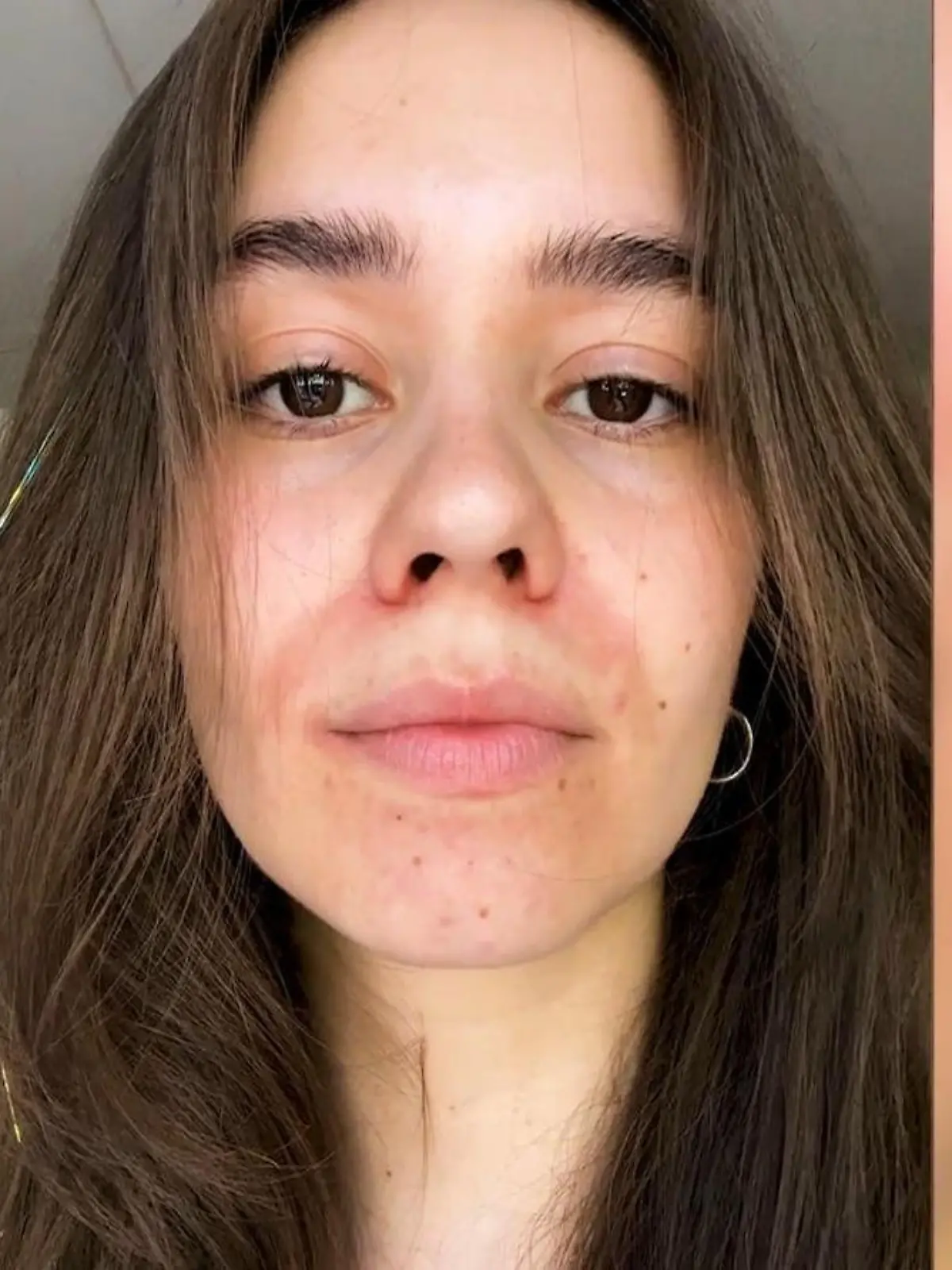 Bild zu: "Lin (25) hatte periorale Dermatitis – woher kommt das und was hilft?"