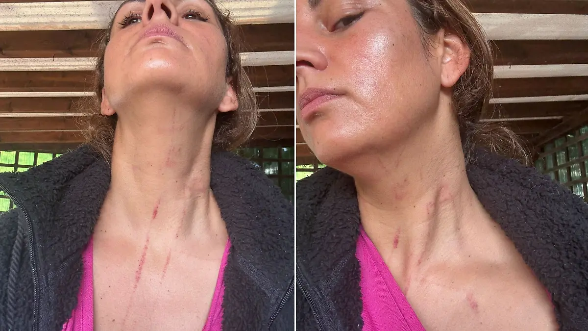 Senay Fröhlich mit Blessuren am Hals und im Gesicht.