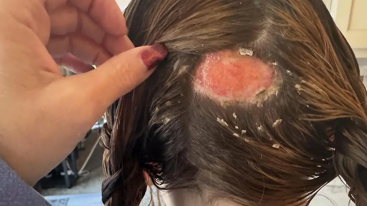 Loch am Hinterkopf! Schülerin (18) hat nach Friseurbesuch Höllenschmerzen Riesige Brandnarbe