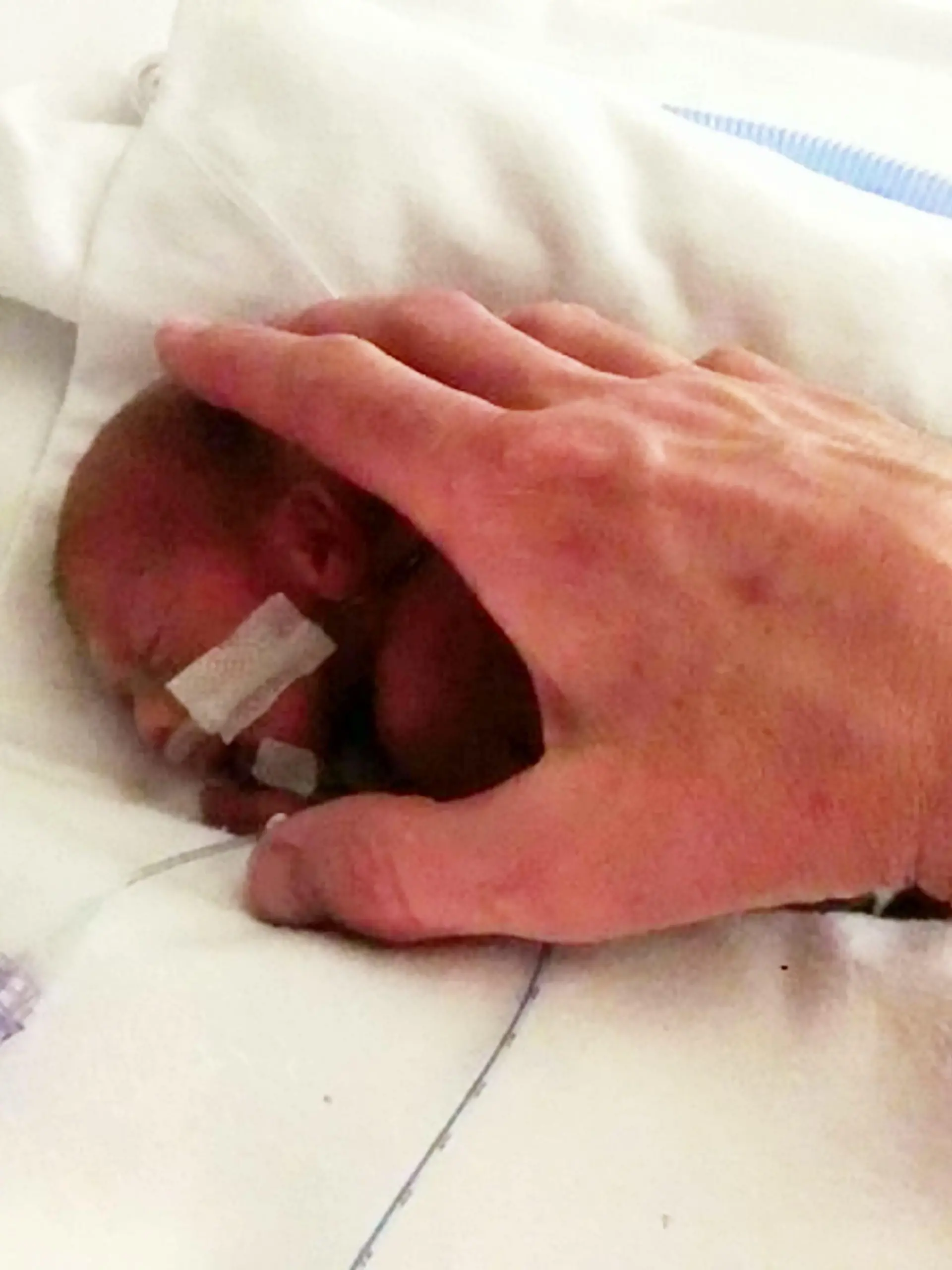 Sonderhonorar! Jett Morris: Ärzte rieten seinen Eltern zur Abtreibung - heute ist er ein Jahr alt! - Jett Morris pictured just after he was born at Queen Alexandra Hospital, Portsmouth. See MASONS story MNMIRACLE: A couple who claim they were pressured to abort her 'non-viable' unborn baby son are  celebrating his first birthday after proving doctors wrong. Little Jett (corr) Morris survived for five weeks in the womb after his mum's waters broke when she was just 20 weeks pregnant. He was born at 25 weeks weighing just 1.4lbs - less than a bag of sugar - and has now grown into a healthy one year-old. But parents Mhairi and Paul say their baby boy would not be here today if they had succumbed to pressure from medics to terminate the pregnancy.