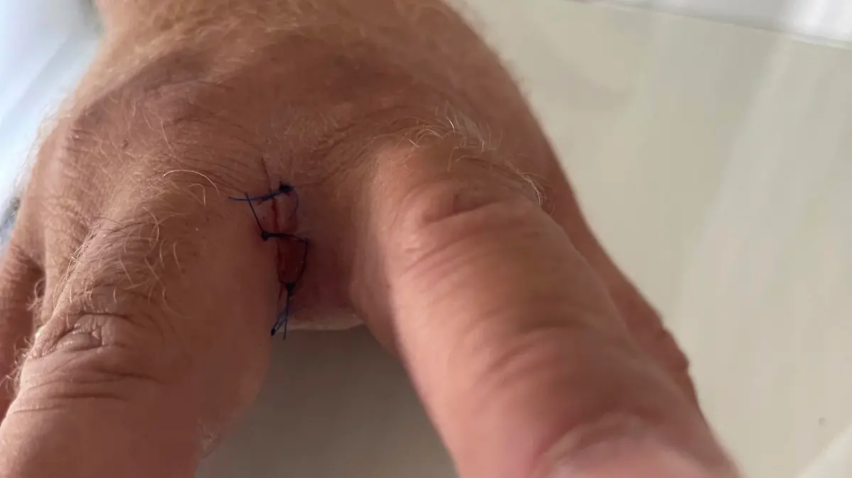Mit vier Stichen musste die Wunder genäht werden.