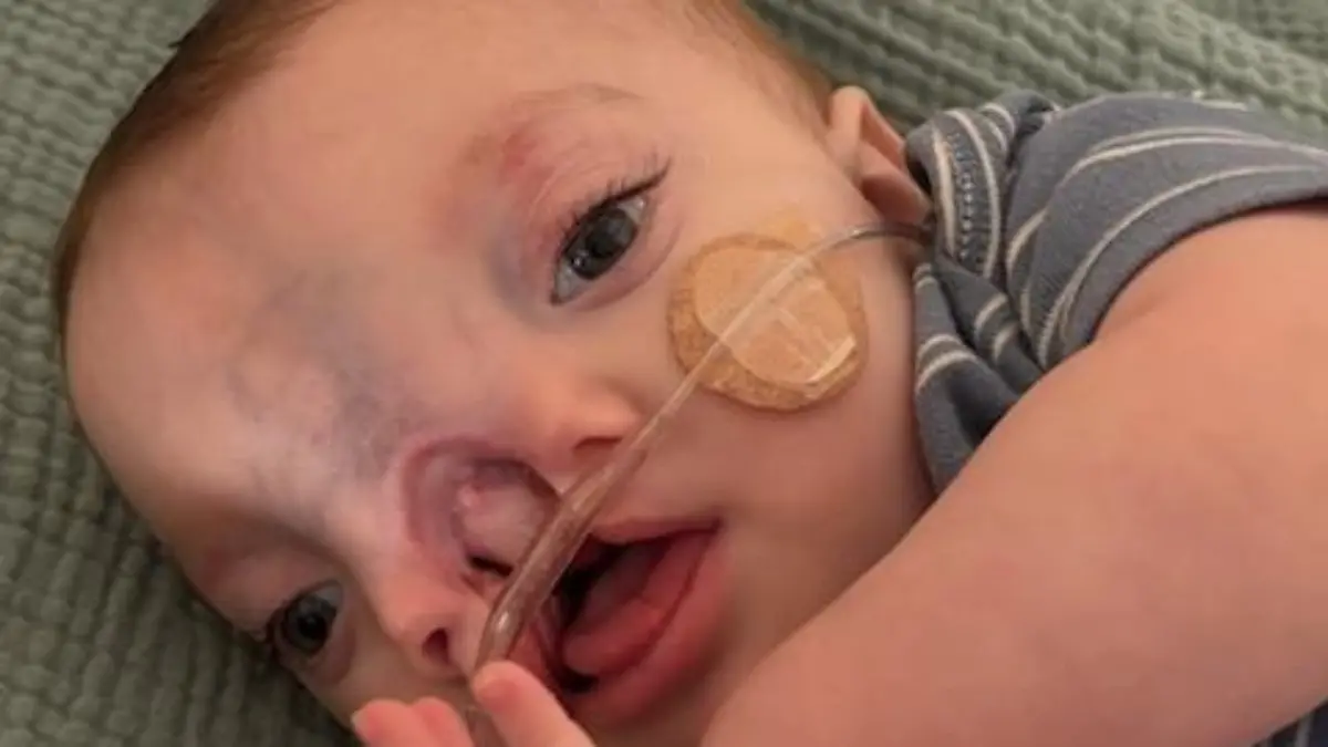 Brody Shain wurde mit einer schweren beidseitigen Lippen-Kiefer-Gaumenspalte geboren. 