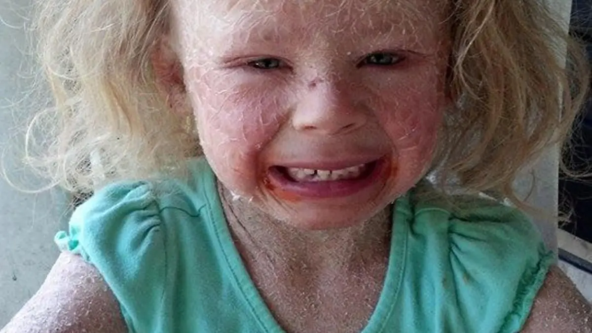 PIC FROM CATERS NEWS - (PICTURED: Georgia struggling to live normally with her condition ) - A young girl is the most excited child around that winter is getting closer as it means she can finally play outside. Georgia Mitchell, from Harlan, Kentucky, has had to sit and watch her friends play all summer but now is excitedly counting down the days until she can join them. The five-year-old suffers from an extremely rare skin condition - Non Bullous Congenital Ichthyosiform Erythroderma which causes her skin to be covered in scales and sun exposure brings on excruciating pain. But after being told Georgia wouldnt live past two weeks, mum Misty says staying out of the sun is a small price to pay to have her daughter here. SEE CATERS COPY