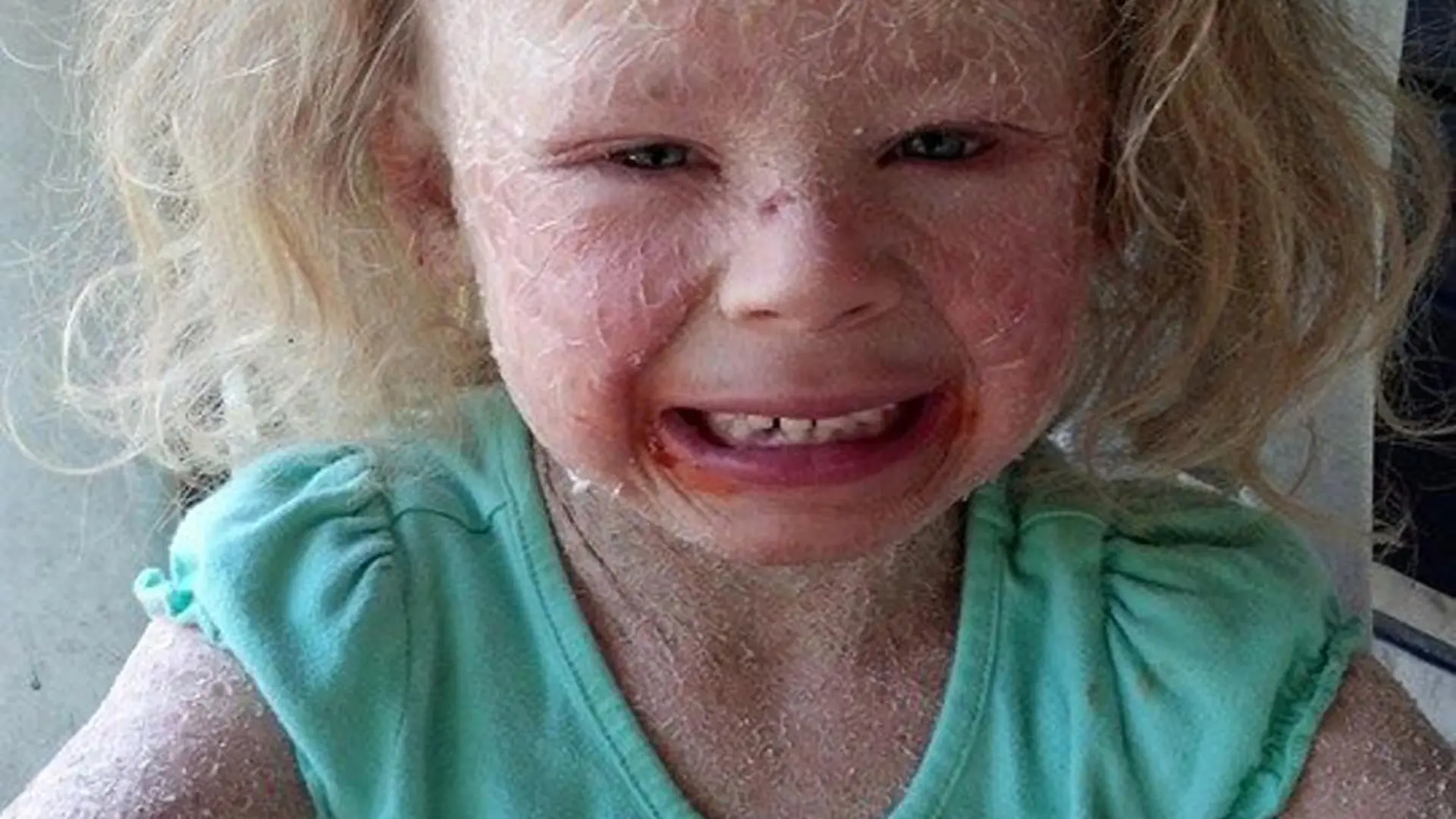 PIC FROM CATERS NEWS - (PICTURED: Georgia struggling to live normally with her condition ) - A young girl is the most excited child around that winter is getting closer as it means she can finally play outside. Georgia Mitchell, from Harlan, Kentucky, has had to sit and watch her friends play all summer but now is excitedly counting down the days until she can join them. The five-year-old suffers from an extremely rare skin condition - Non Bullous Congenital Ichthyosiform Erythroderma which causes her skin to be covered in scales and sun exposure brings on excruciating pain. But after being told Georgia wouldnt live past two weeks, mum Misty says staying out of the sun is a small price to pay to have her daughter here. SEE CATERS COPY