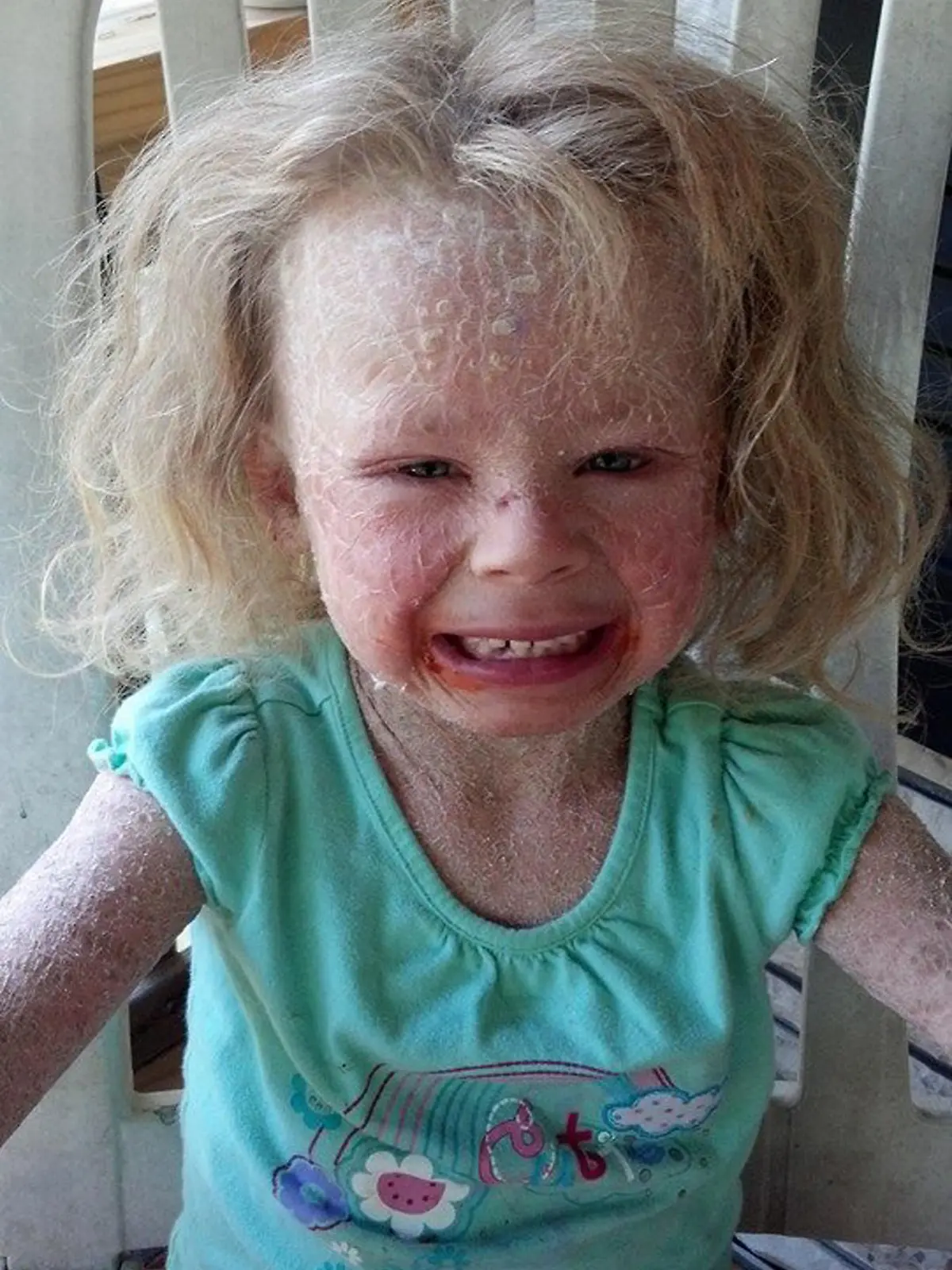 PIC FROM CATERS NEWS - (PICTURED: Georgia struggling to live normally with her condition ) - A young girl is the most excited child around that winter is getting closer as it means she can finally play outside. Georgia Mitchell, from Harlan, Kentucky, has had to sit and watch her friends play all summer but now is excitedly counting down the days until she can join them. The five-year-old suffers from an extremely rare skin condition - Non Bullous Congenital Ichthyosiform Erythroderma  which causes her skin to be covered in scales and sun exposure brings on excruciating pain. But after being told Georgia wouldnt live past two weeks, mum Misty says staying out of the sun is a small price to pay to have her daughter here. SEE CATERS COPY 