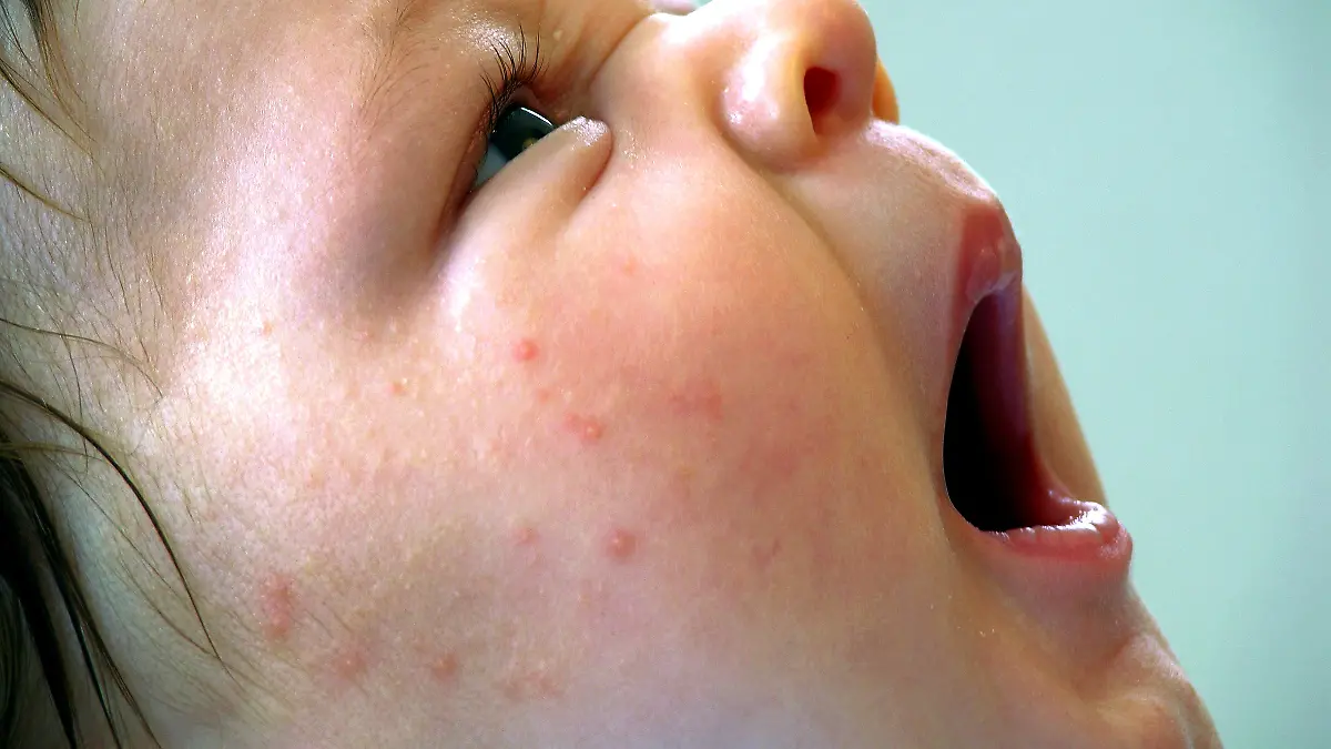 Ein zehn Wochen altes Baby gähnt mit weit offenem Mund, aufgenommen am 09.07.2004 in Filderstadt. Auf der Wange haben sich Pickel einer Baby-Akne gebildet, eine harmlose Hautkrankheit, die meist innerhalb kurzer Zeit ohne weitere Behandlung wieder abklingt. Foto: Jürgen Effner +++(c) dpa - Report+++