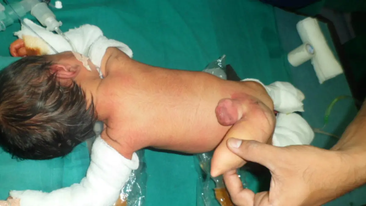 Ahmedabad India: Before surgery.A baby boy born with heteropagus conjoined twinning. The parasitic twin consisted of a 12-cm limb on the boyâ€Ös back that resembled a tail. The total weight of the autosite and parasite was 2.7kg. The surgery was performed earlier this month by a team of 3 paediatricians and they successfully removed the extra limb weighing 350 grams, had developed Meningomyelocele, a congenital deformity that can lead to cancer.Image supplied by Cover Asia Press