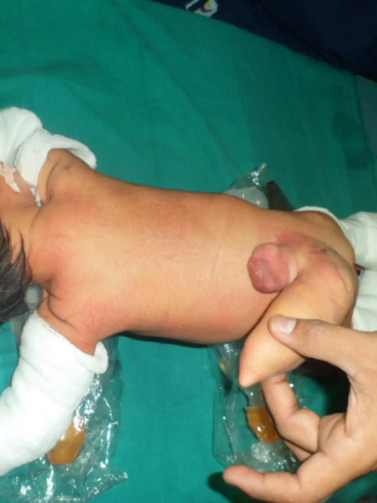 Ahmedabad India: Before surgery.A baby boy born with heteropagus conjoined twinning. The parasitic twin consisted of a 12-cm limb on the boyâ€Ös back that resembled a tail. The total weight of the autosite and parasite was 2.7kg. The surgery was performed earlier this month by a team of 3 paediatricians and they successfully removed the extra limb weighing 350 grams, had developed Meningomyelocele, a congenital deformity that can lead to cancer.Image supplied by Cover Asia Press