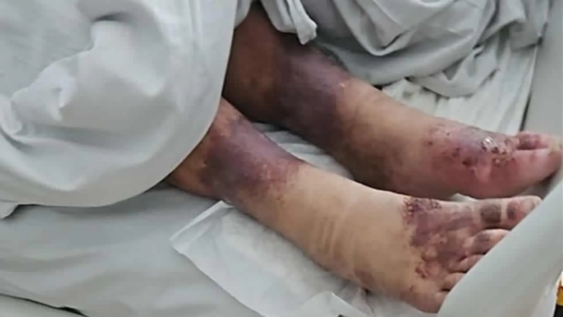 Mirella muss nach der Rettung im Krankenhaus behandelt werden 