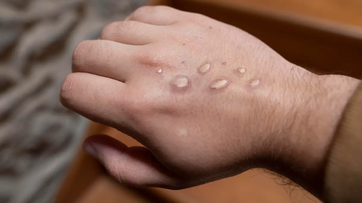 Monkey pox vesicles in a hand