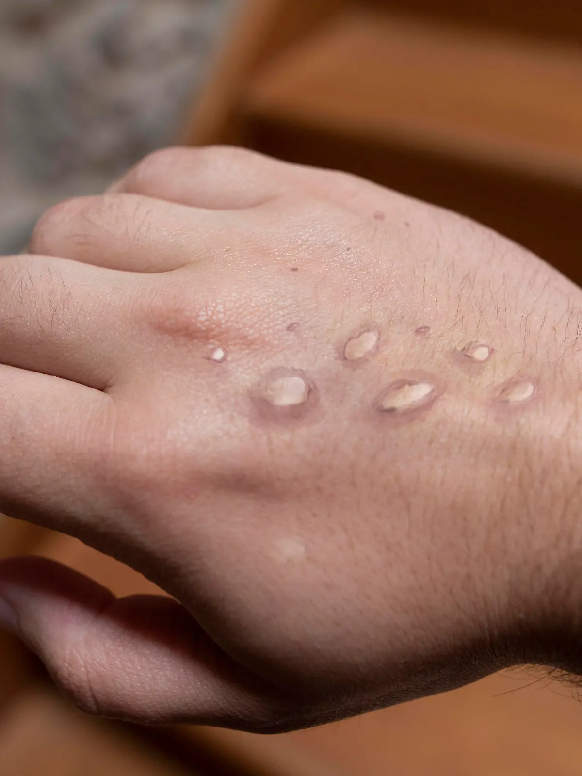 Monkey pox vesicles in a hand