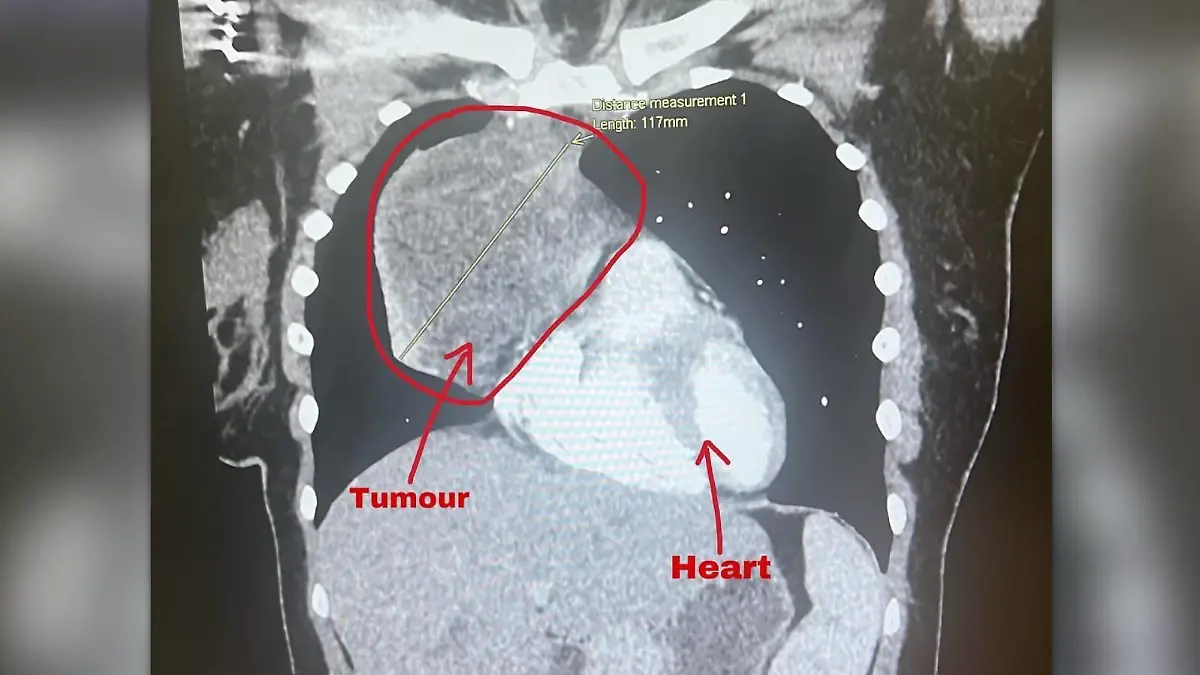 MRT-Bild des großen Tumors neben Zoes Herz