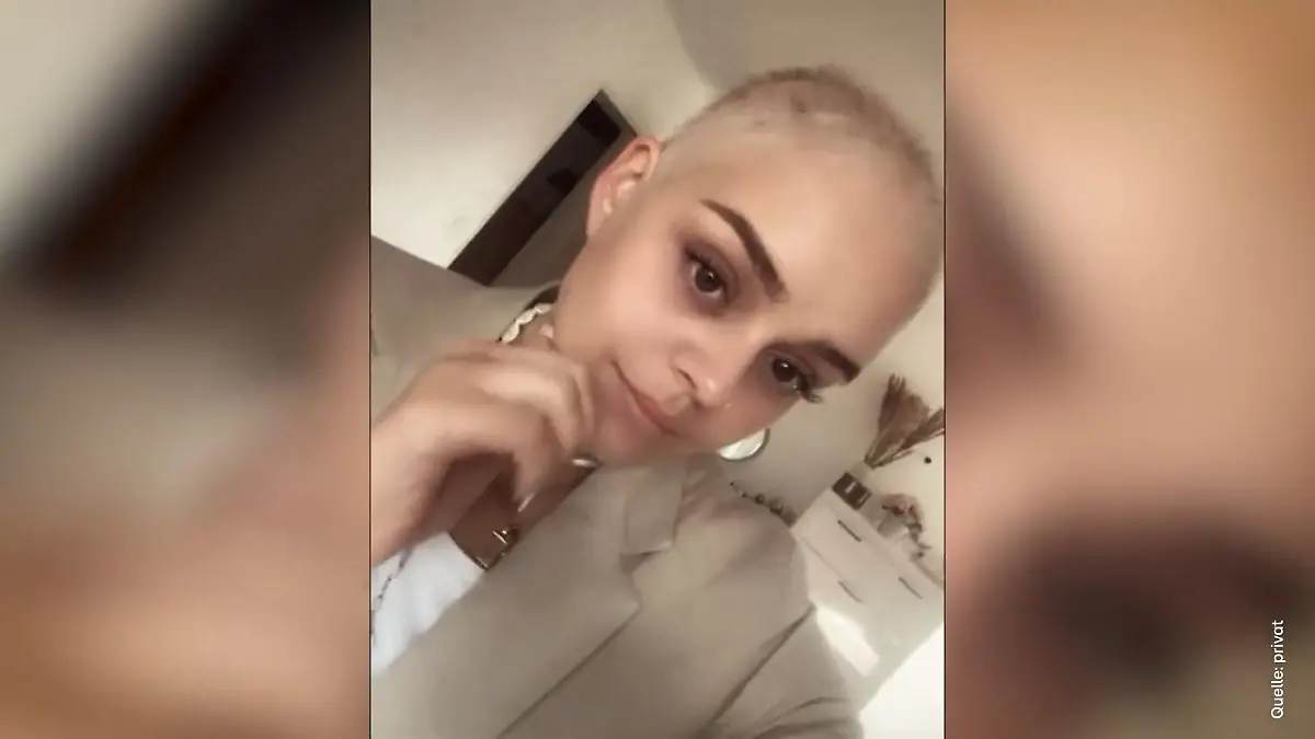 Schock im Urlaub! Plötzlich fallen Leonie alle Haare aus Sie hat Alopecia areata