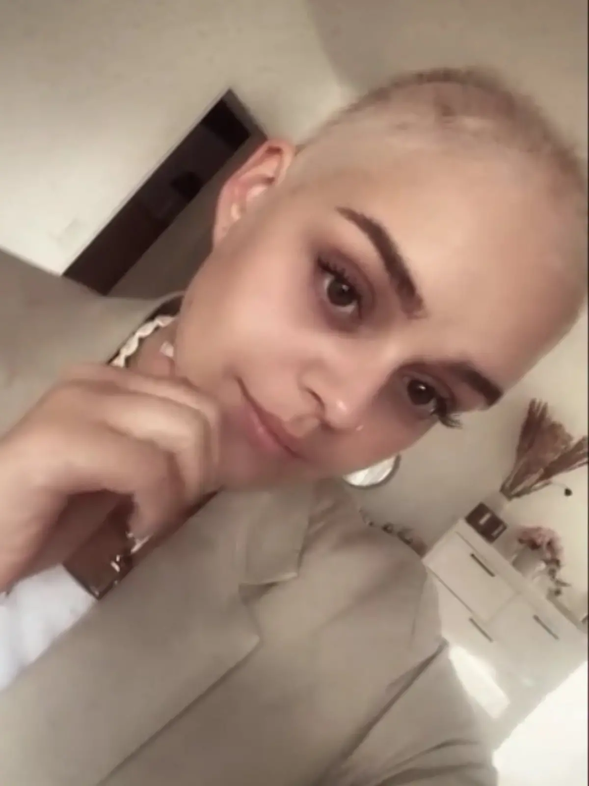 Bild zu: "„Es wurden viele Tränen vergossen” – Leonie (24) fallen plötzlich alle Haare aus"