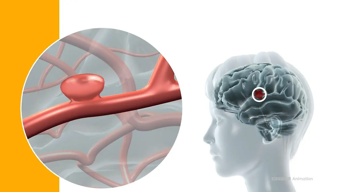 So entsteht ein Aneurysma im Kopf Lebensgefährlich und oft unentdeckt