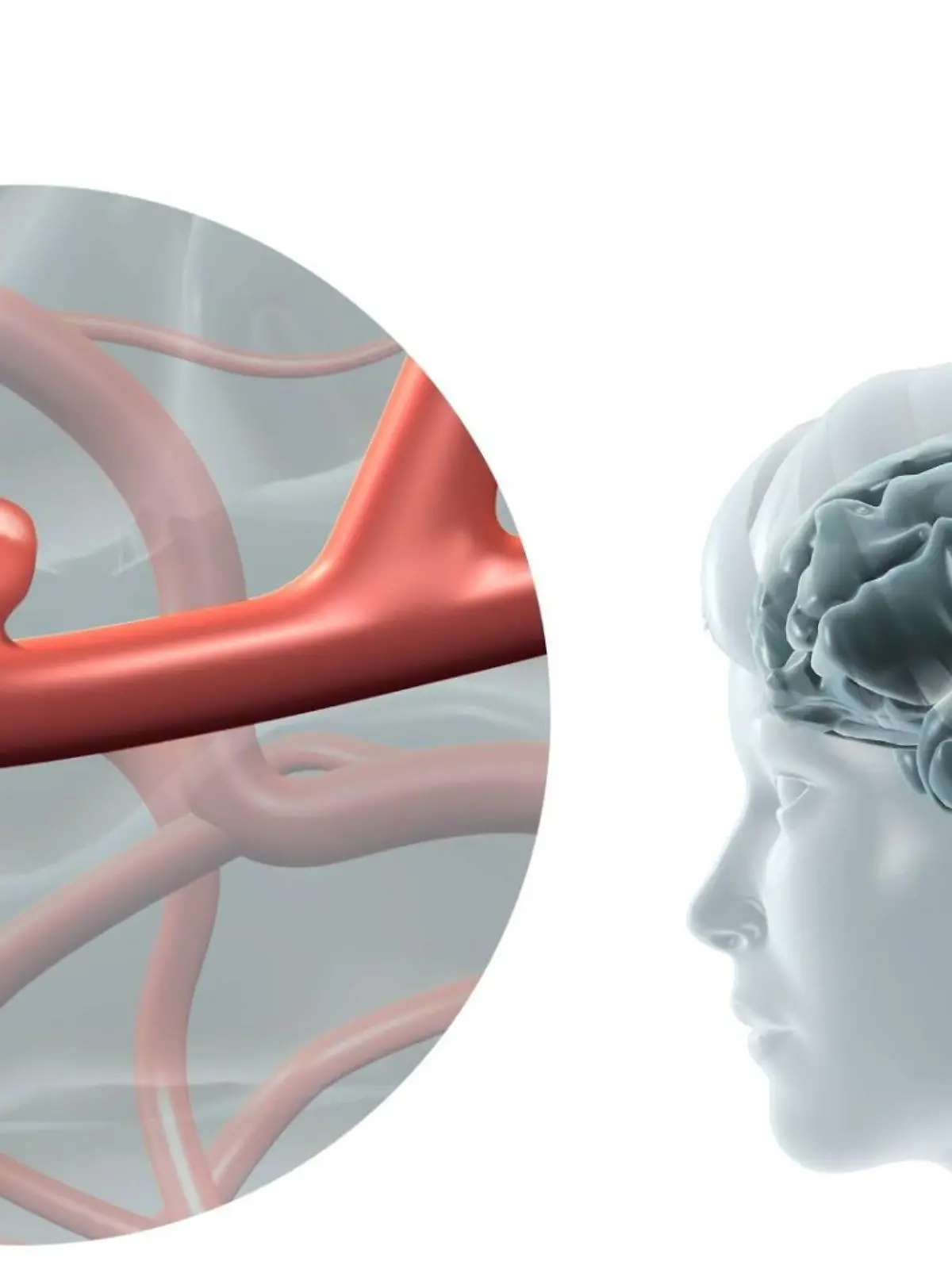 Bild zu: "So entsteht ein Aneurysma im Kopf"