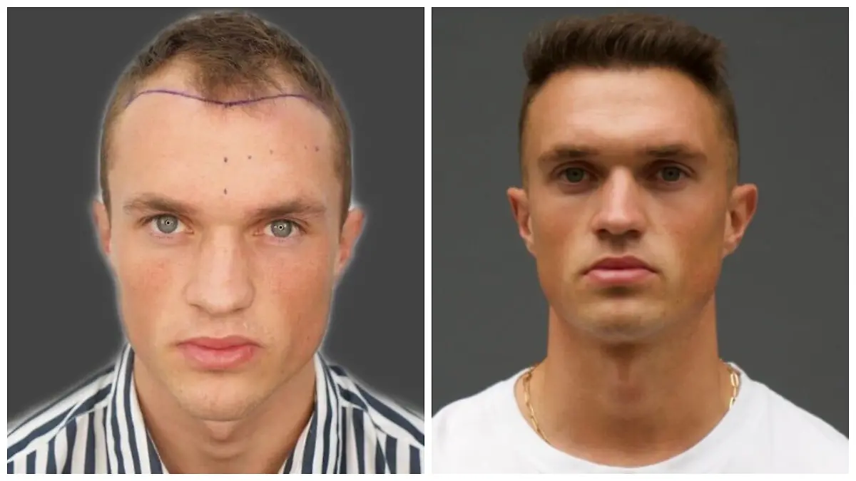 Lars Huxsohl bei seiner Haartransplantation.